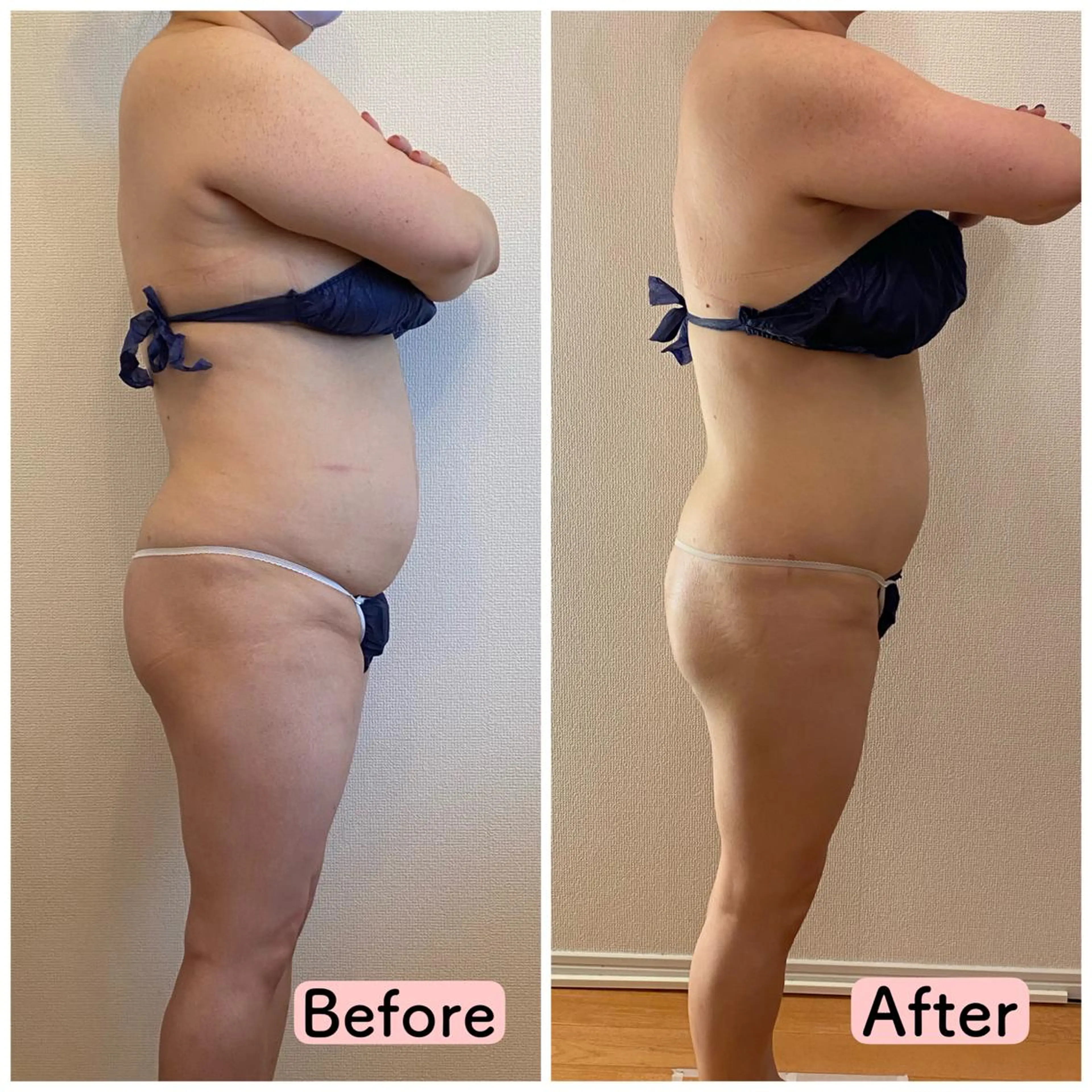 【整形級ダイエット】ぽっこりお腹・腰回り撃退集中ケア🔥🔥🔥くびれを出す事でエロBODYに❤️の写真