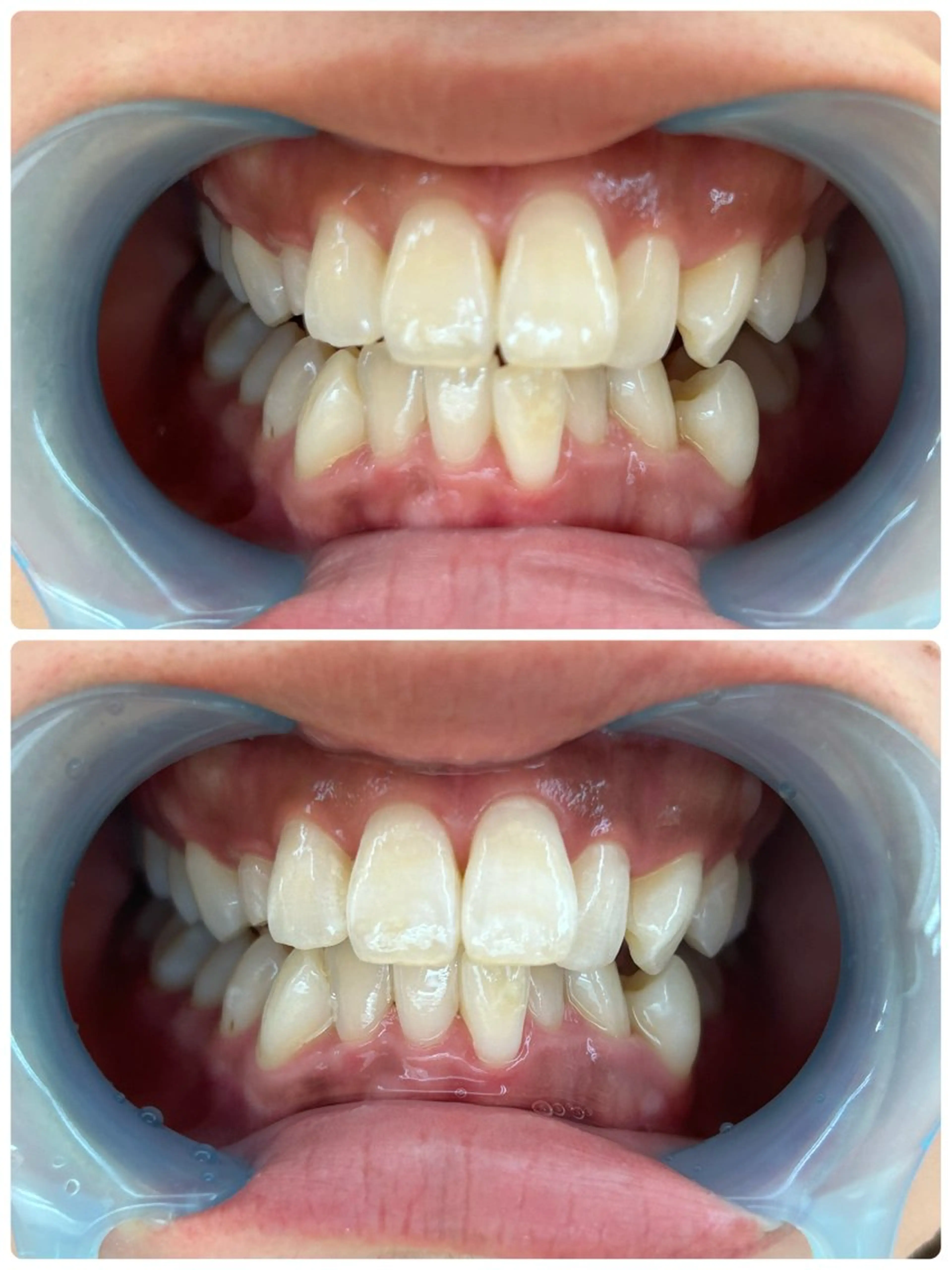 【オプション】セルフホワイトニング🦷✨1回分（15分）無料※メニュー追加必須となります✨✨の写真