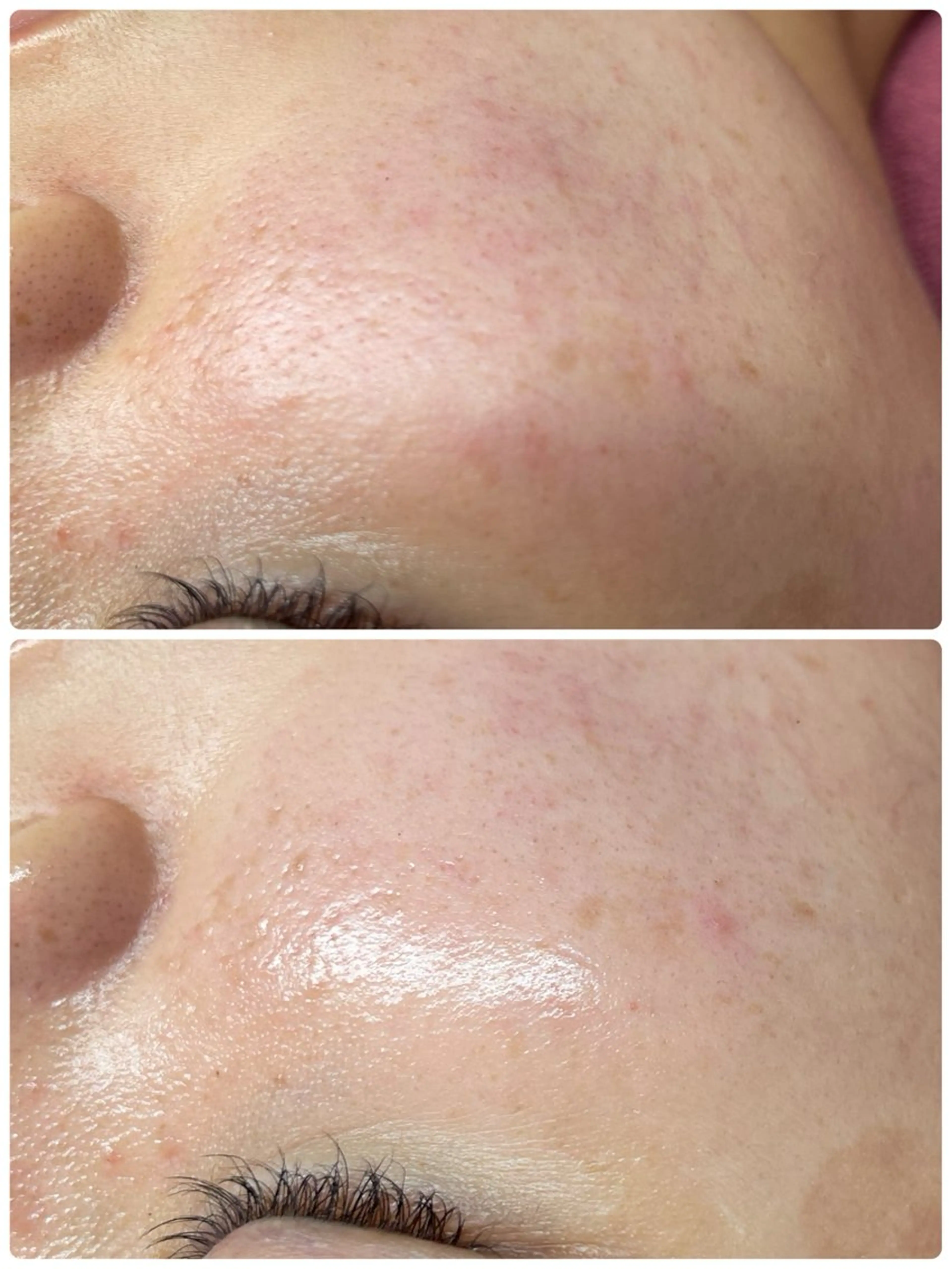 エステ Chalon所属・REVI取扱・肌悩み 毛穴Chalonのエステ・リラクイメージ