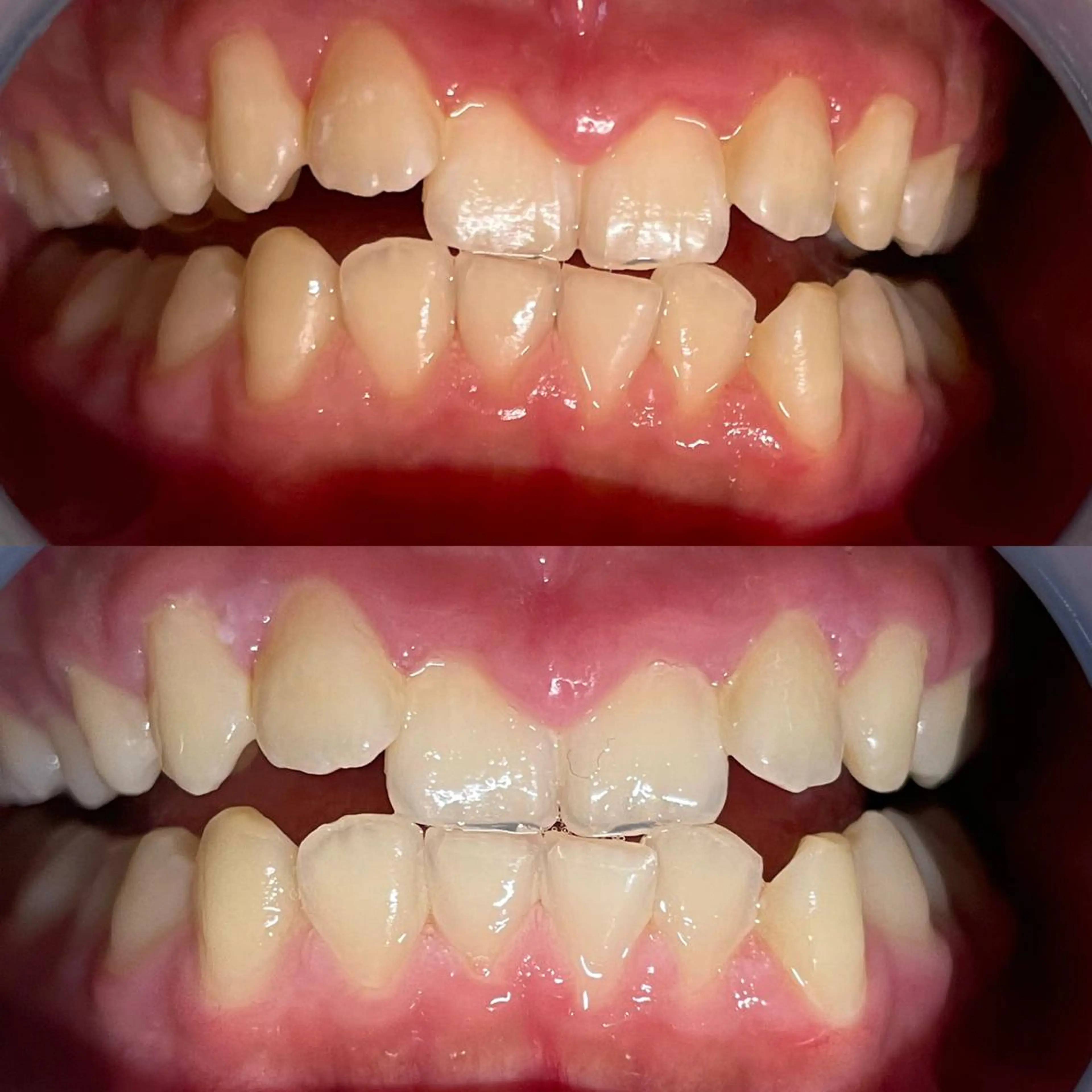 【まずはお試しクーポン】8分×２回照射セルフホワイトニング¥4,980→¥3,980の写真