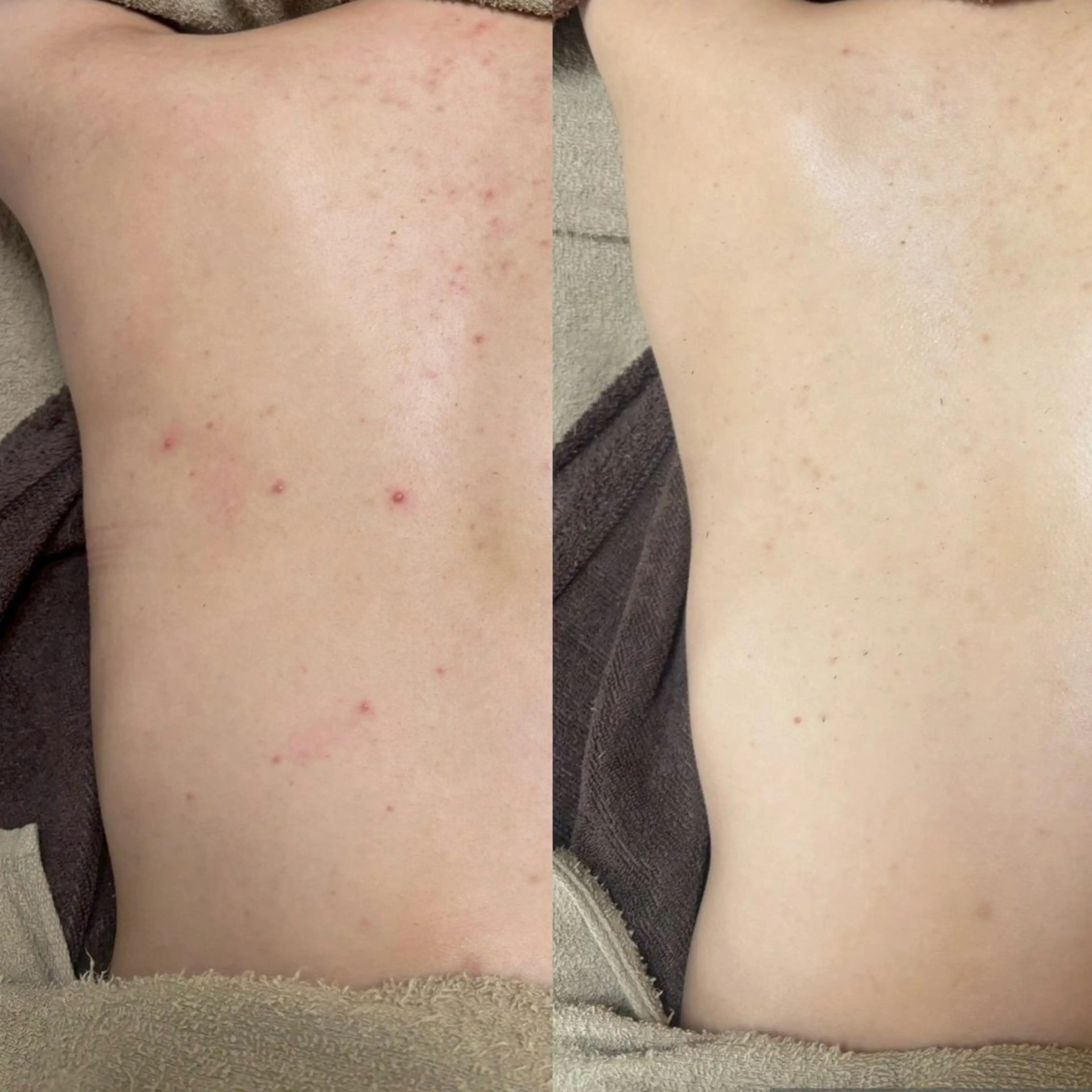 背中ハーブピーリングの写真