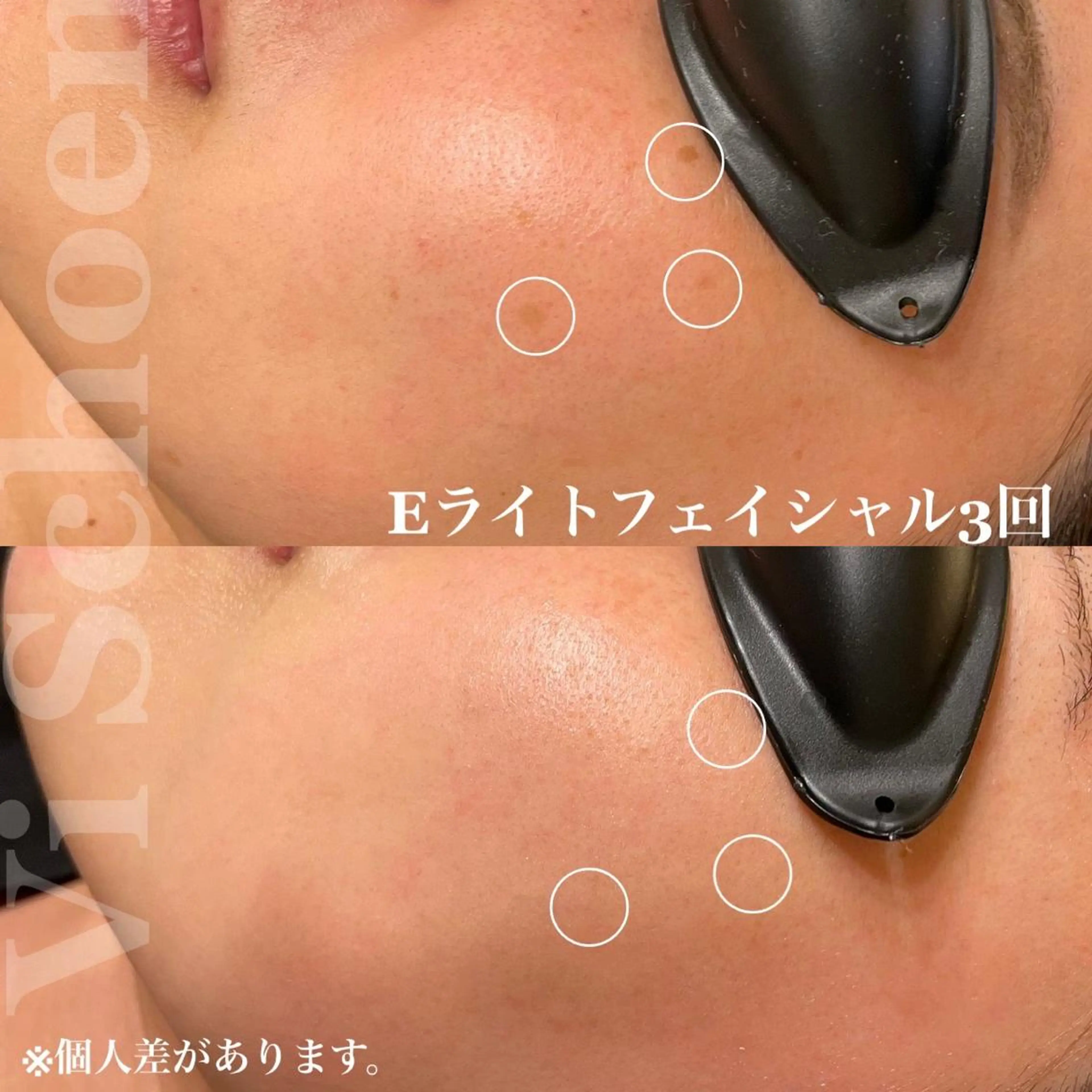 メンズ エステ うなじ/もみあげ脱毛 ヴィシェーン佐藤のその他イメージ