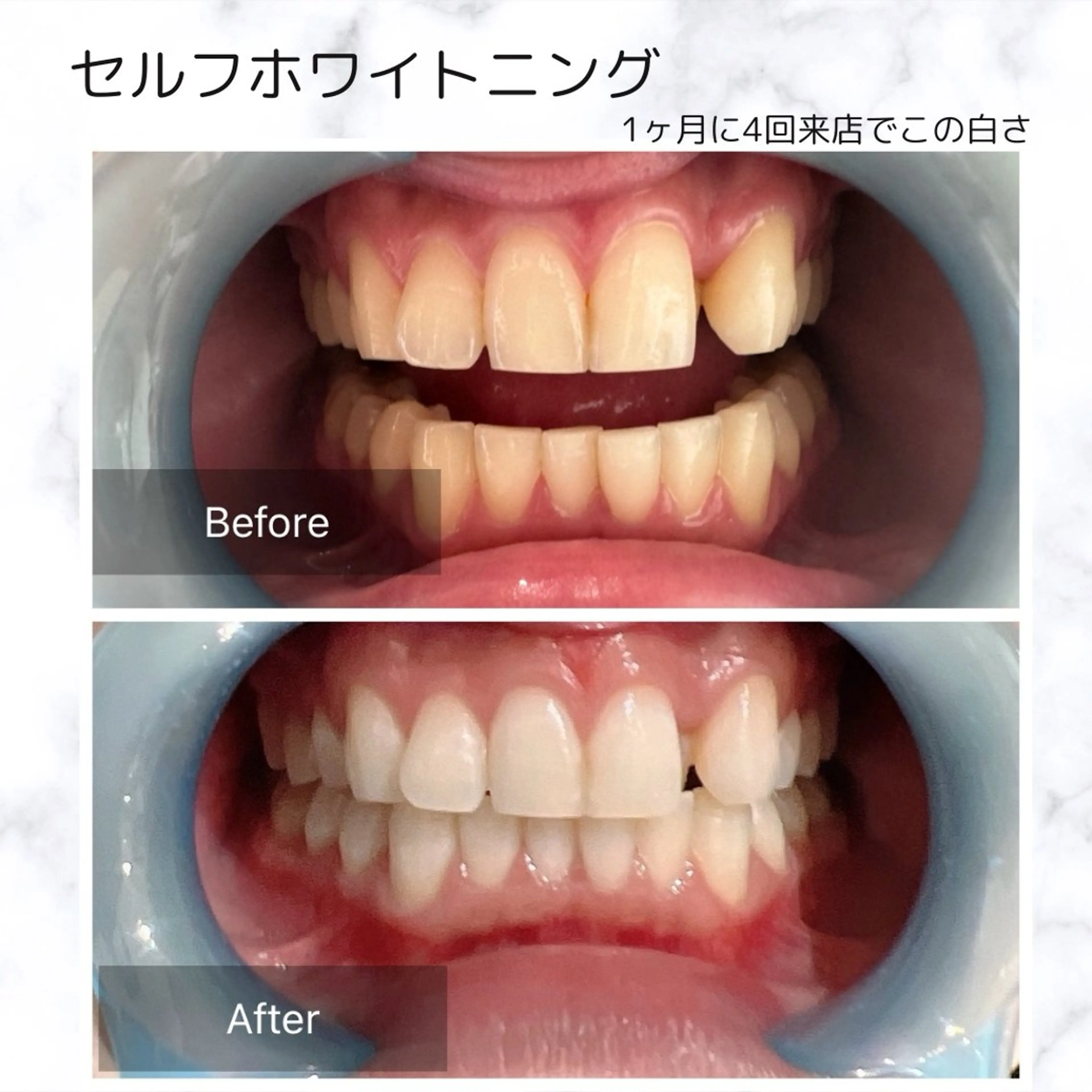【イメージリノベーション】セルフホワイトニングの写真