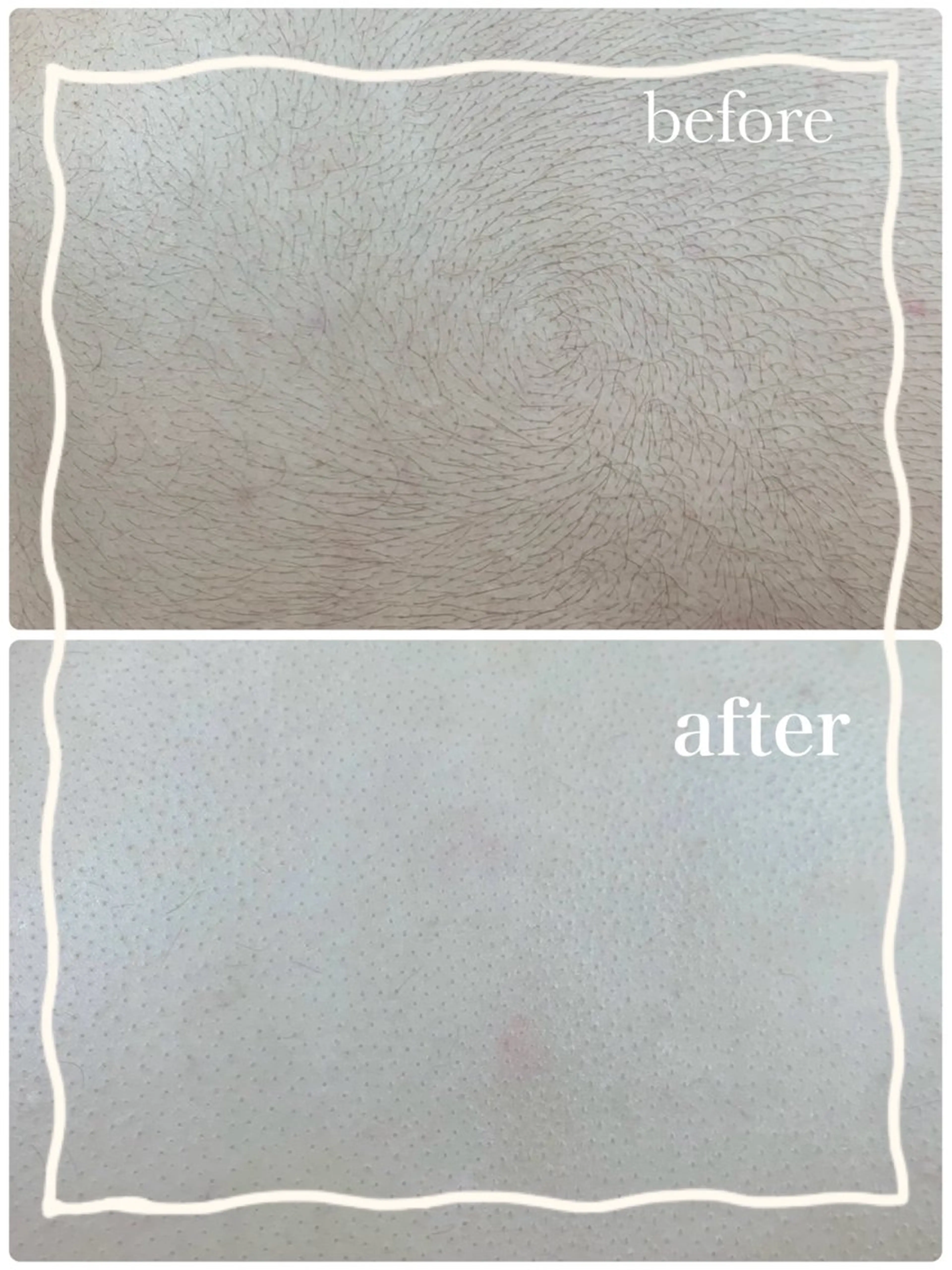 【単品】襟足​〜​背中のシェービングの写真