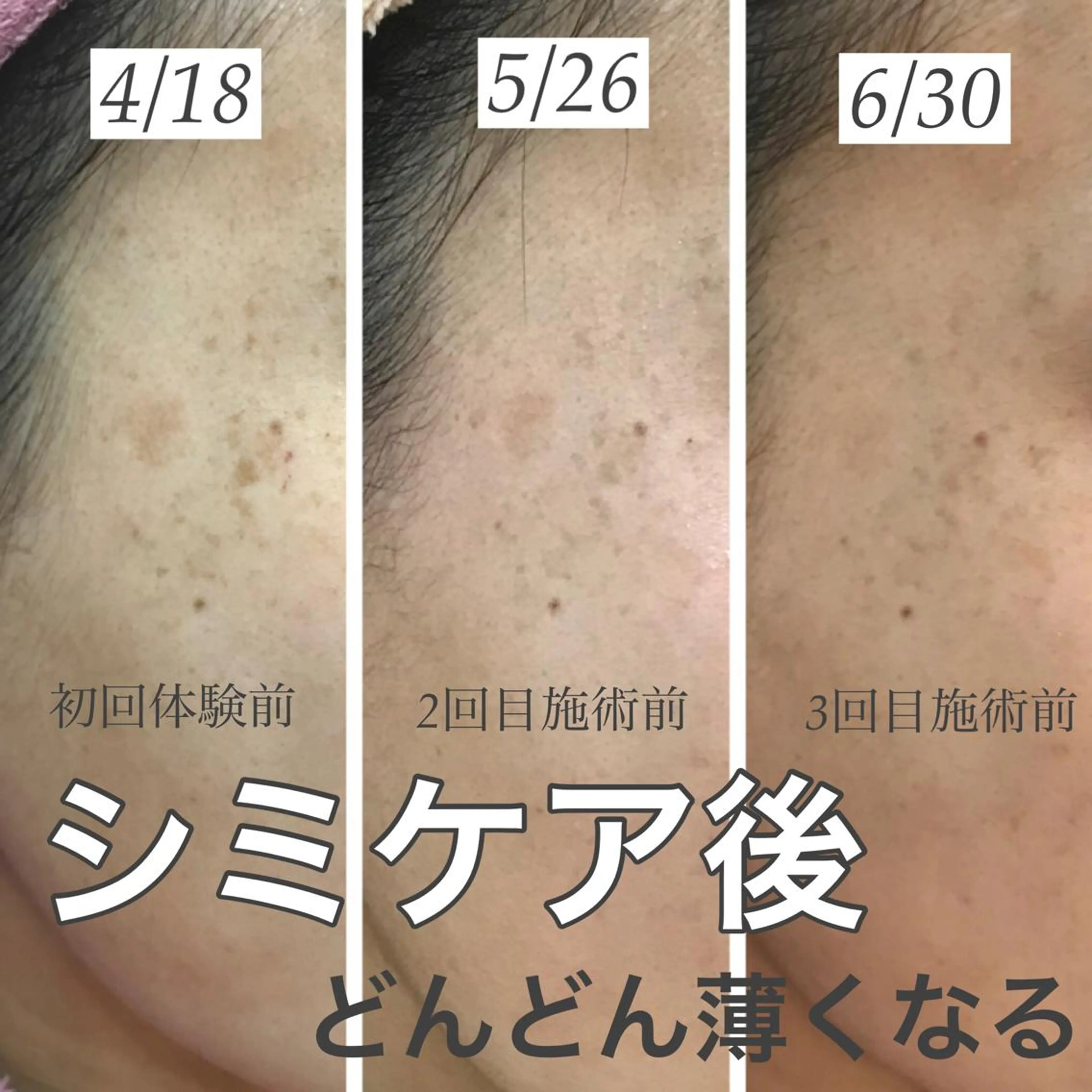 【しみ毛穴専門店】beautysalon Ankh所属・しみ毛穴専門店 Ankh 平田のエステ・リラクイメージ