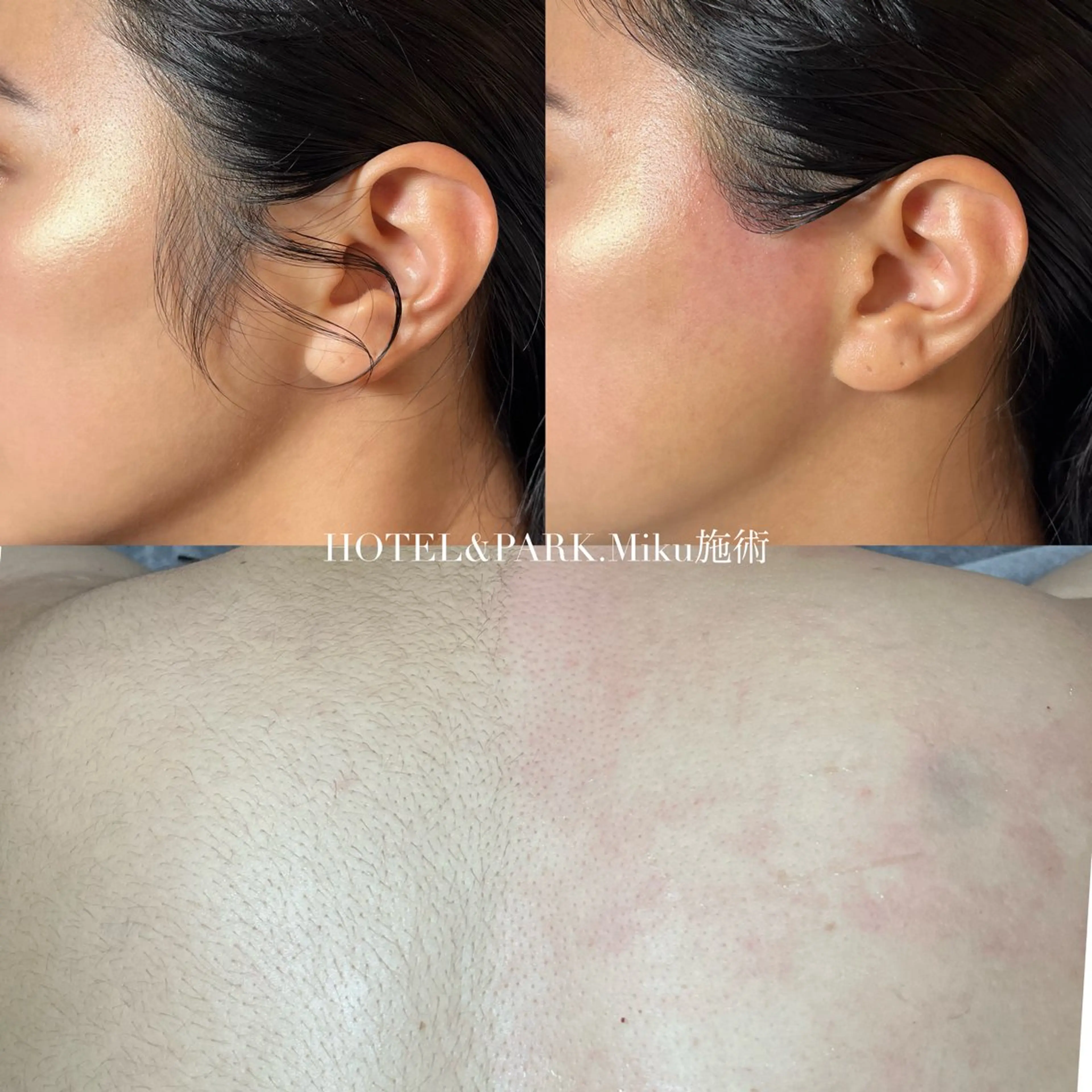 HOLIDAY SALE🎁❄️40%OFF❤️【背中上うなじ込＋1箇所(脇/デコルテ/もみあげ)ワックス脱毛】の写真