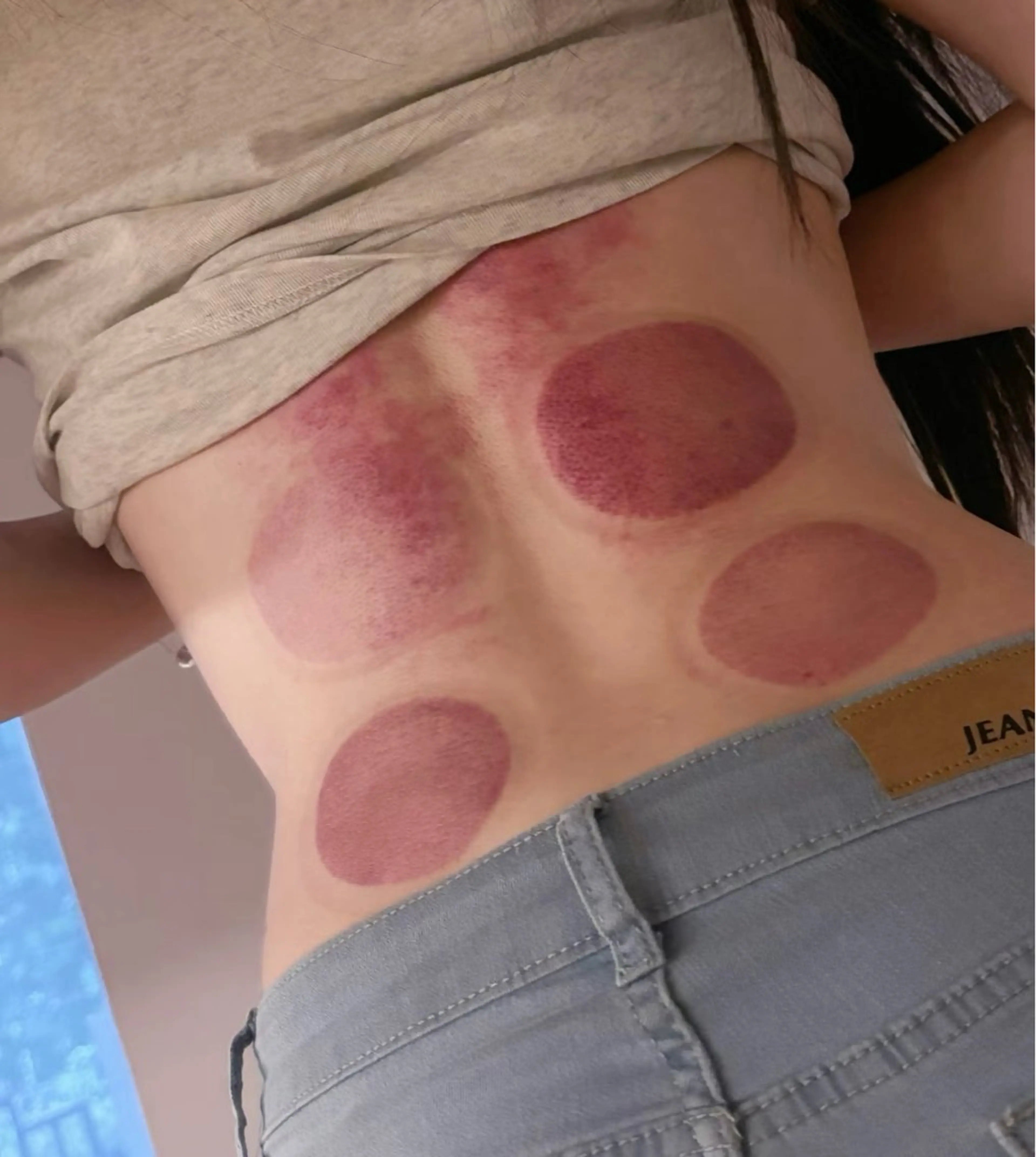 【カッピング】ブラの上のはみ肉撃退！背中・肩改善カッピングの写真