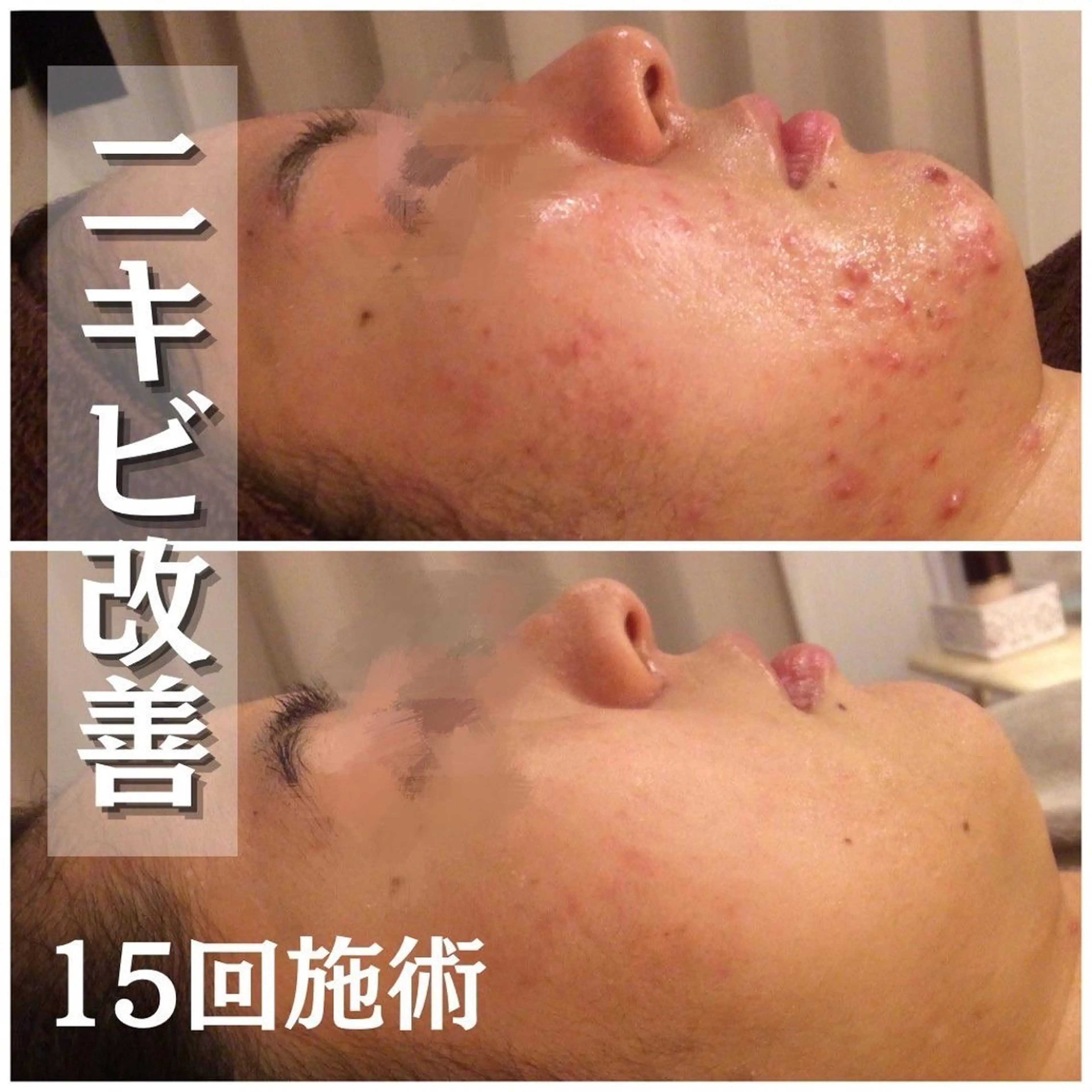 夏までに肌荒れ卒業 するサロン🌻のエステ・リラクイメージ