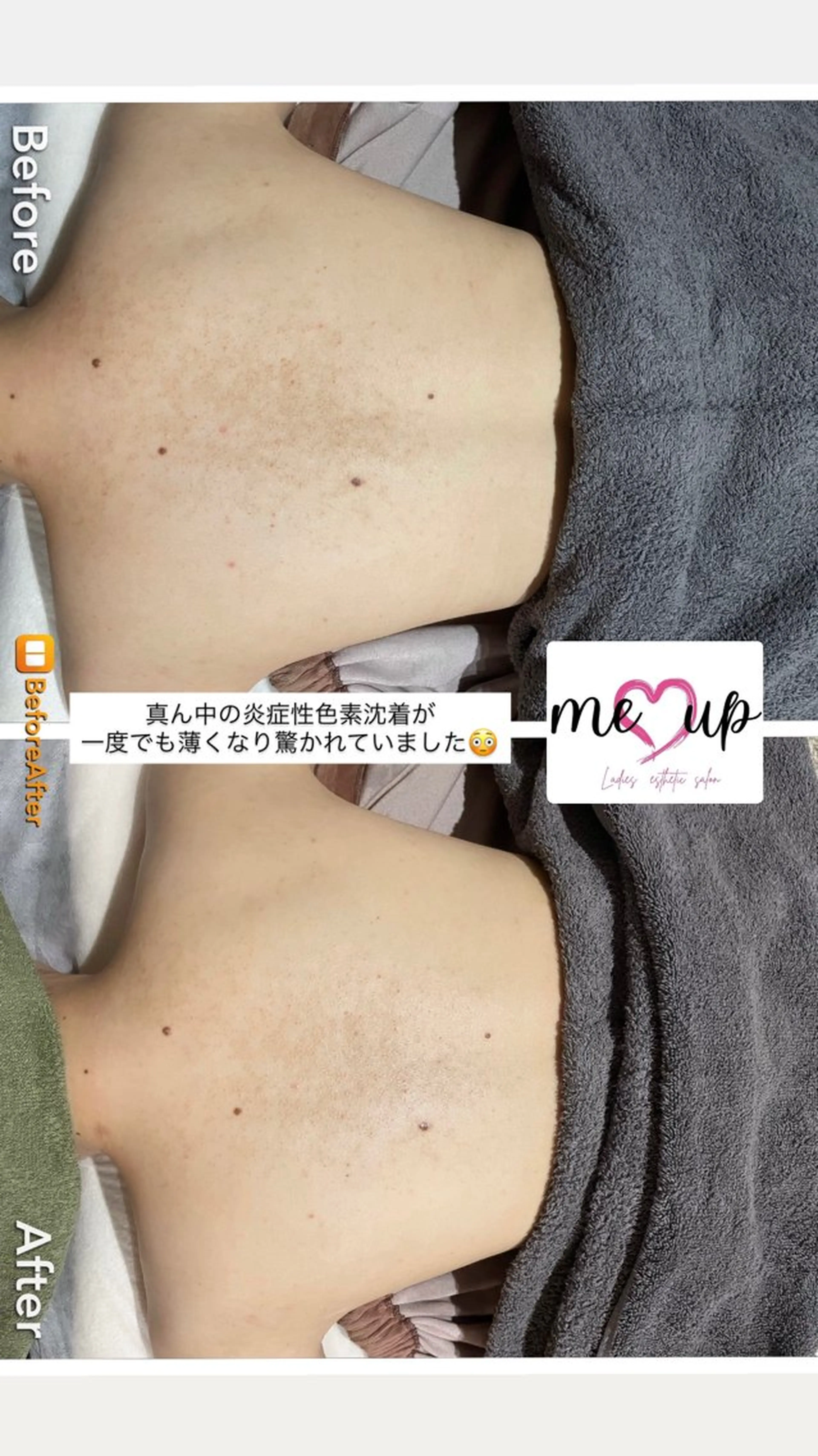 Meupニキビ専門店 背中/ハーブ/肌管理のその他イメージ