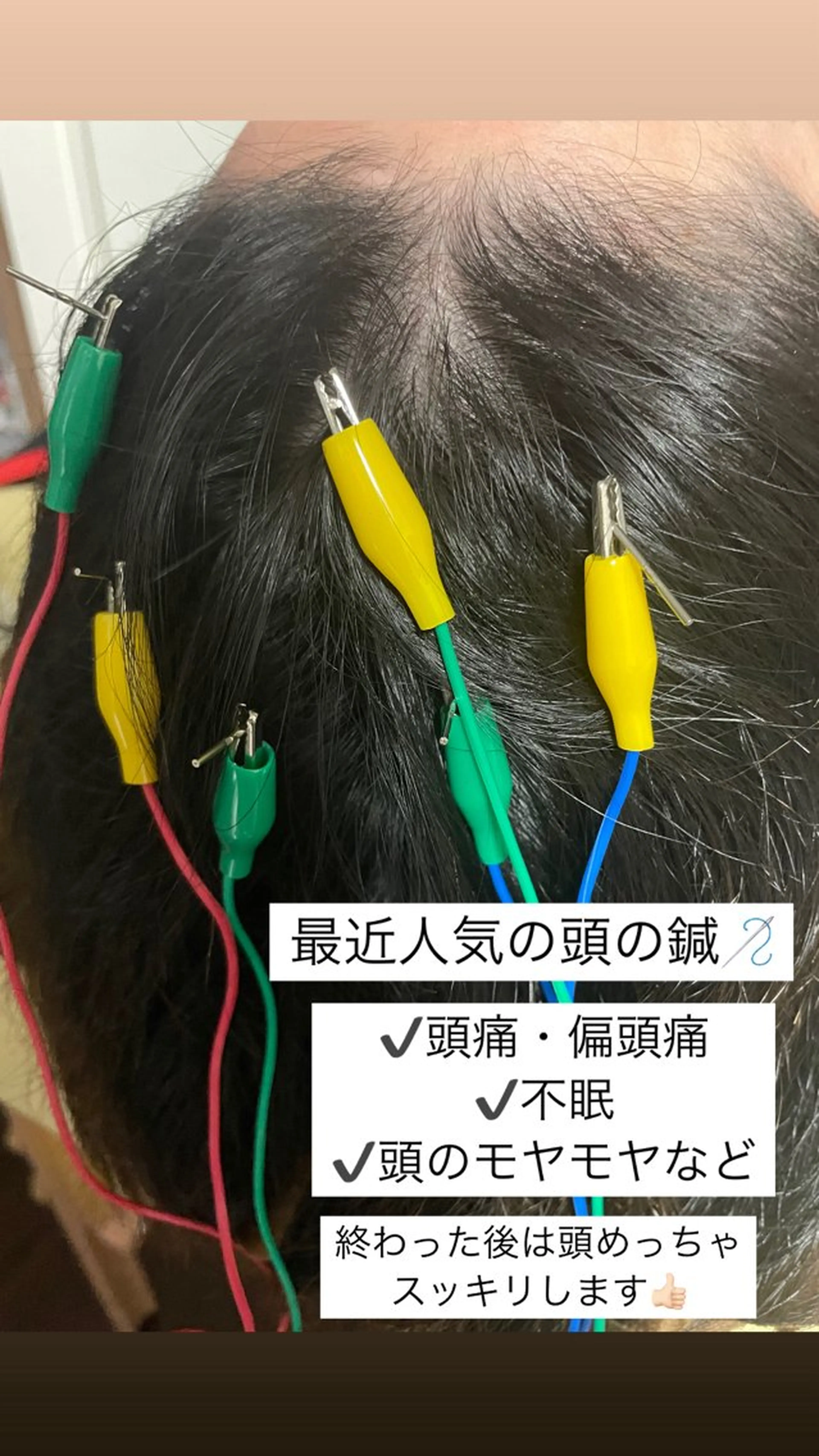 美容鍼/鍼灸 ここみ鍼灸院のエステ・リラクイメージ