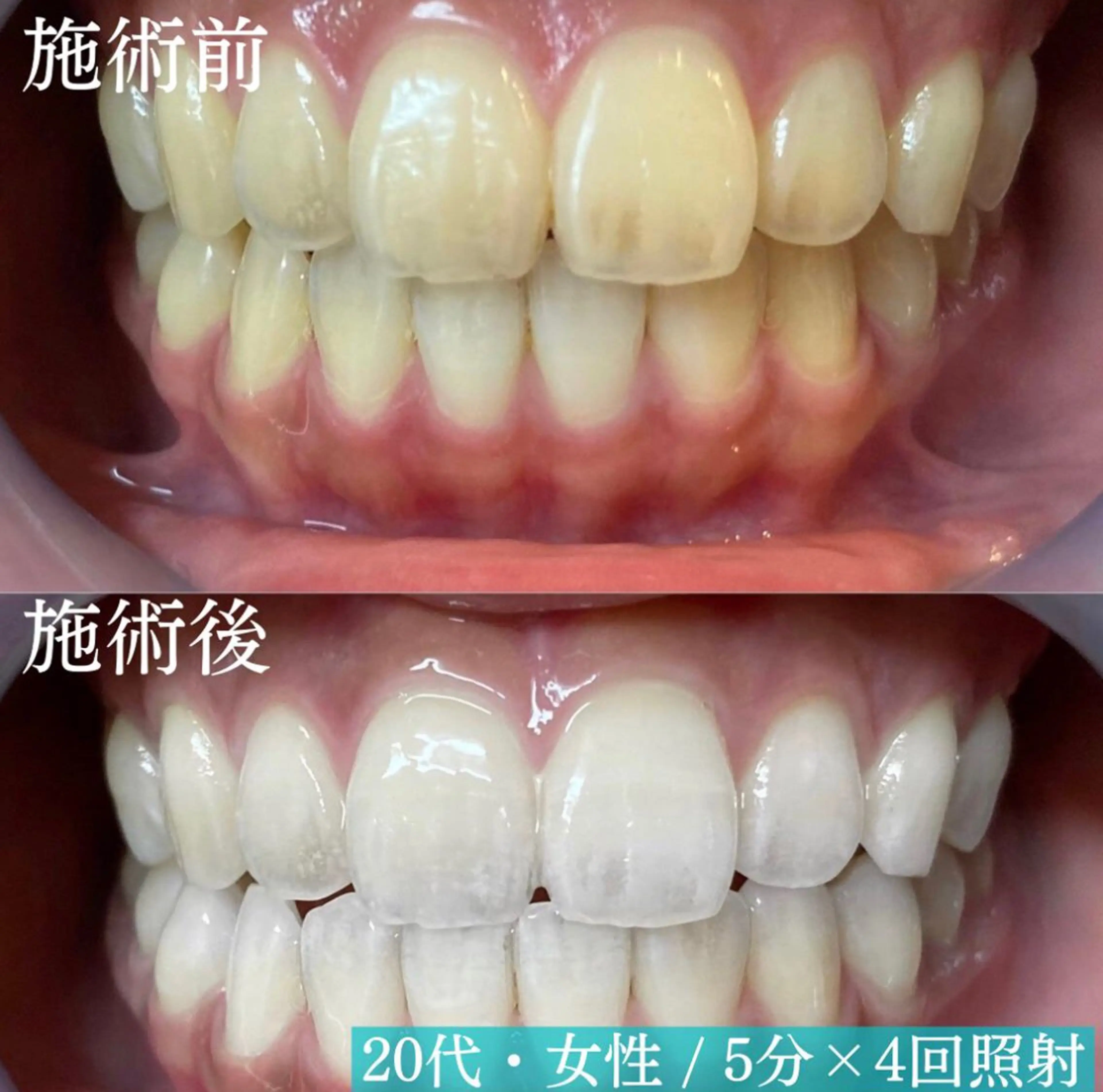 LBSホワイトニング上野店所属・LBSホワイトニング 🌐 上野店公式のエステ・リラクイメージ