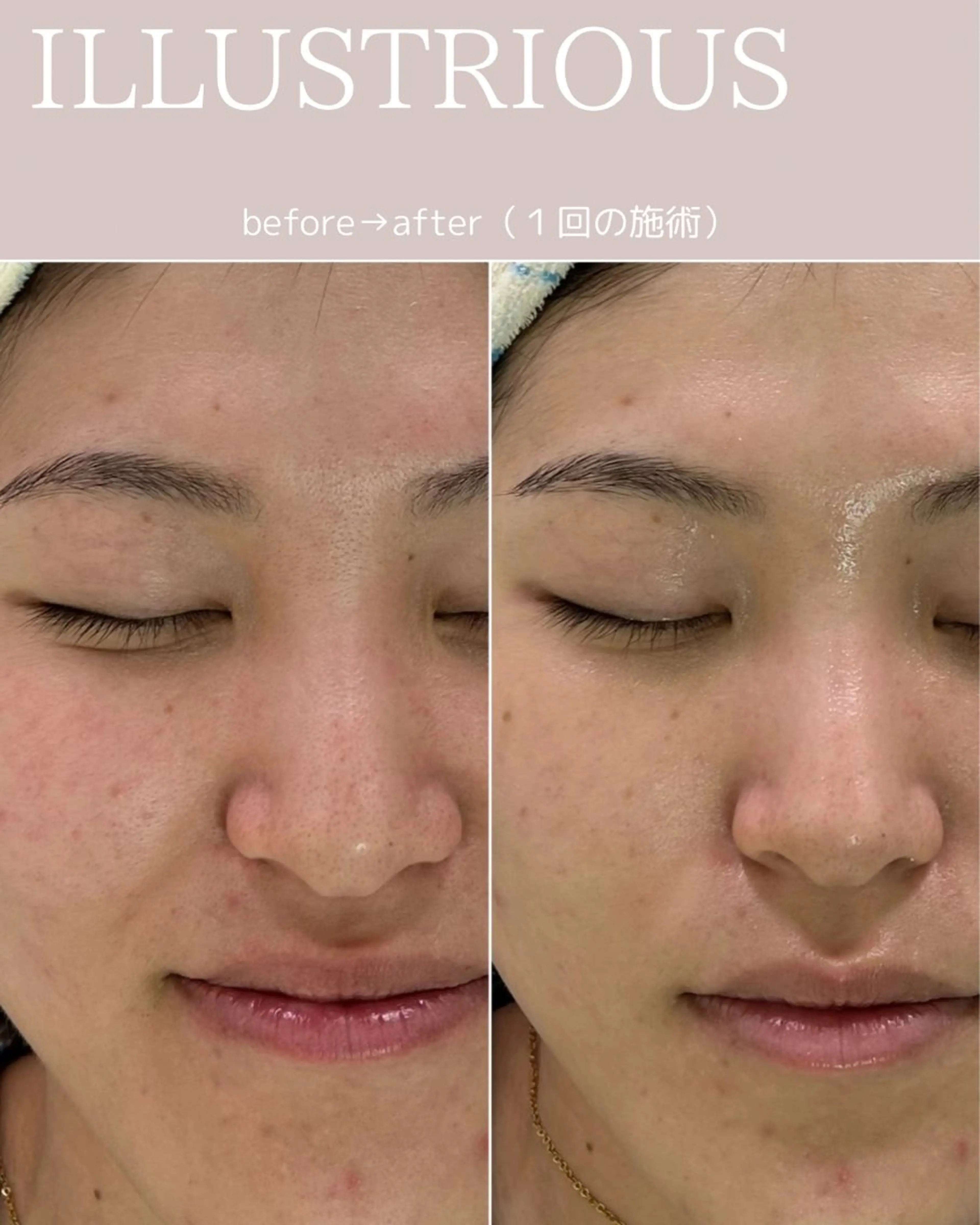 【毛穴•ハーブピーリング】 ニキビ対策サロンétoile クリスティーナ正規取扱店所属・松尾 佳奈のエステ・リラクイメージ