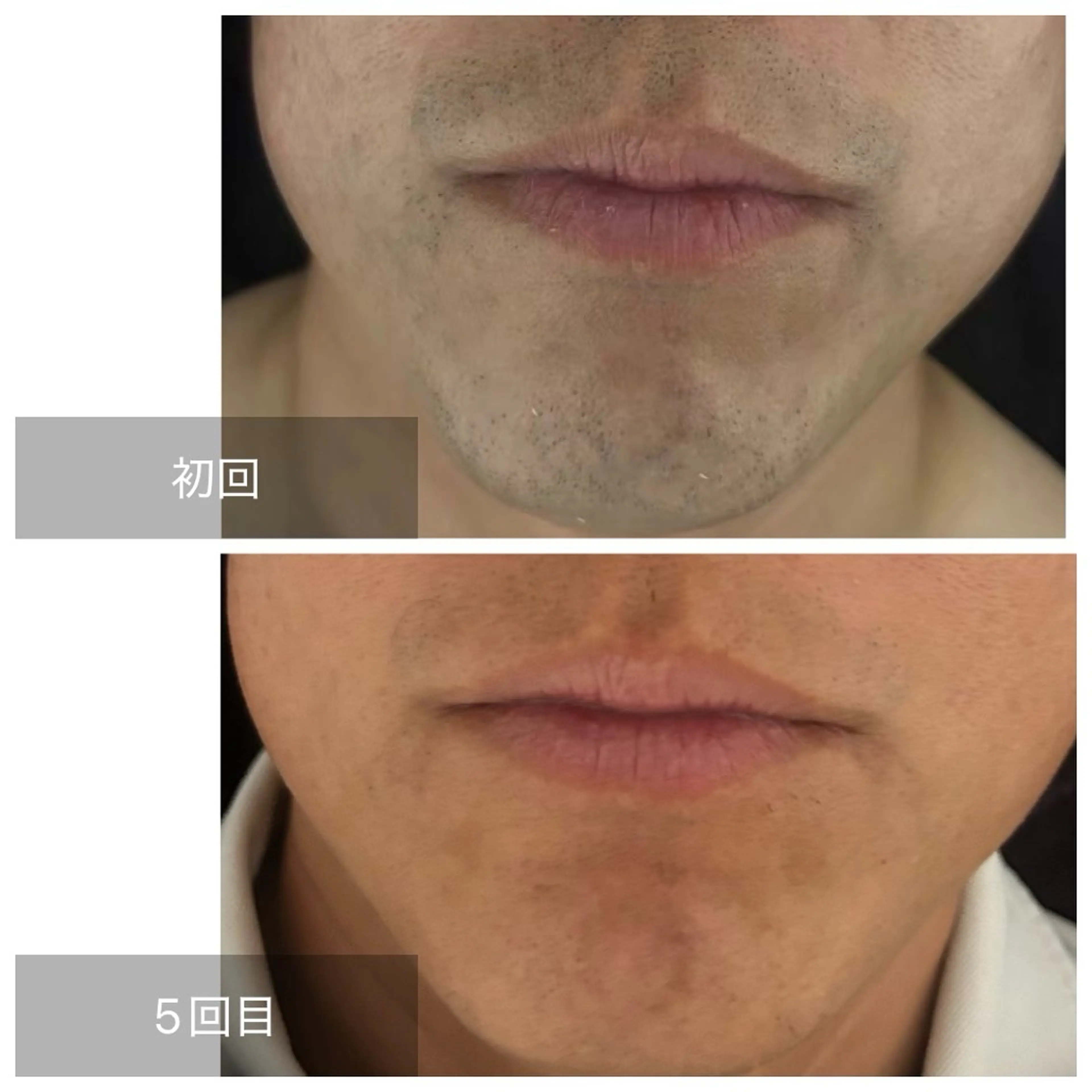 メンズ 脱毛 エマニエル USAのエステ・リラクイメージ