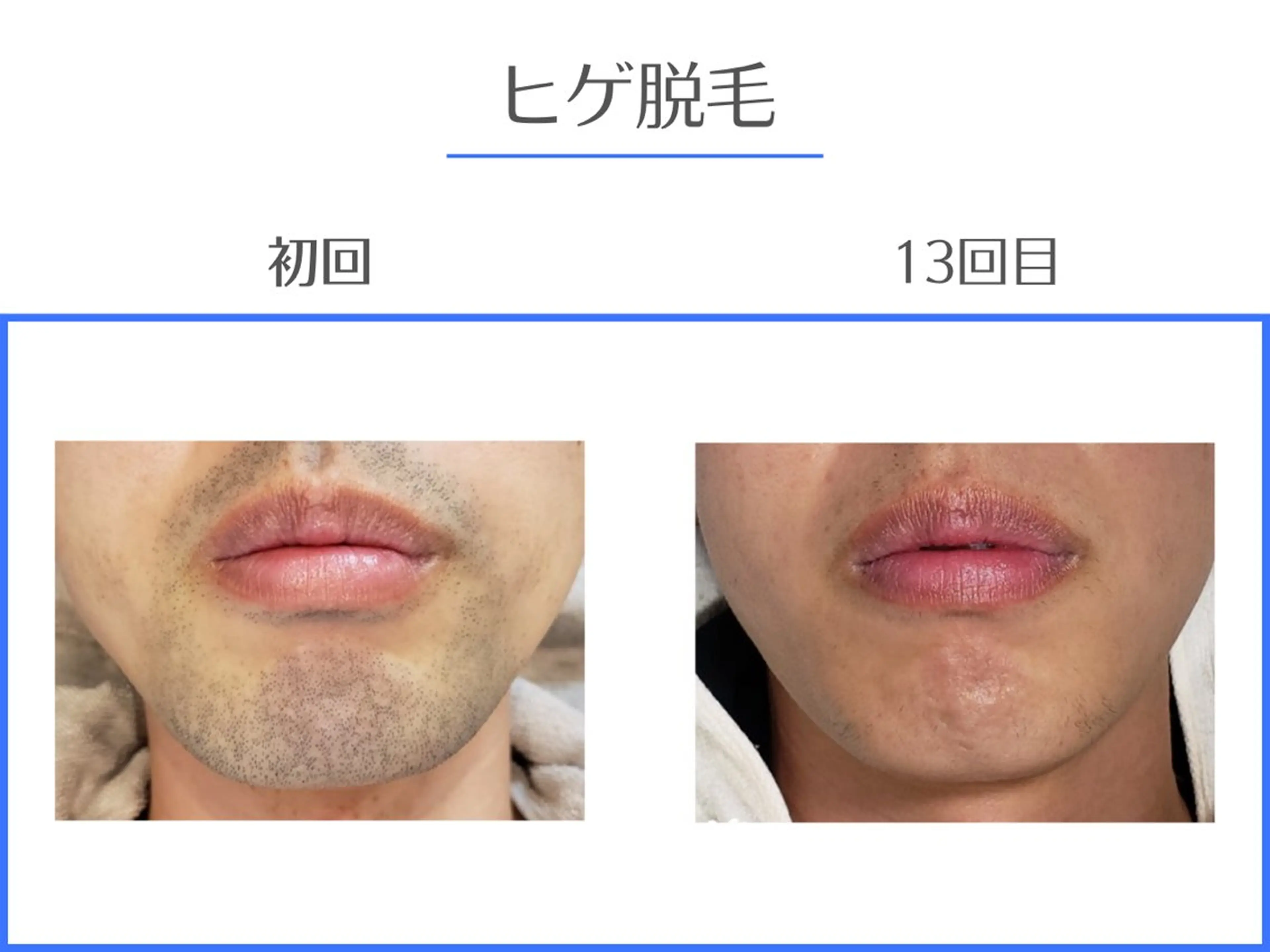 メンズ髭脱毛【あご/あご下/ほほ/鼻下/もみあげ/首】まるっと全パーツ❣️￥5,500→￥3,300最新脱毛器使用✨️の写真