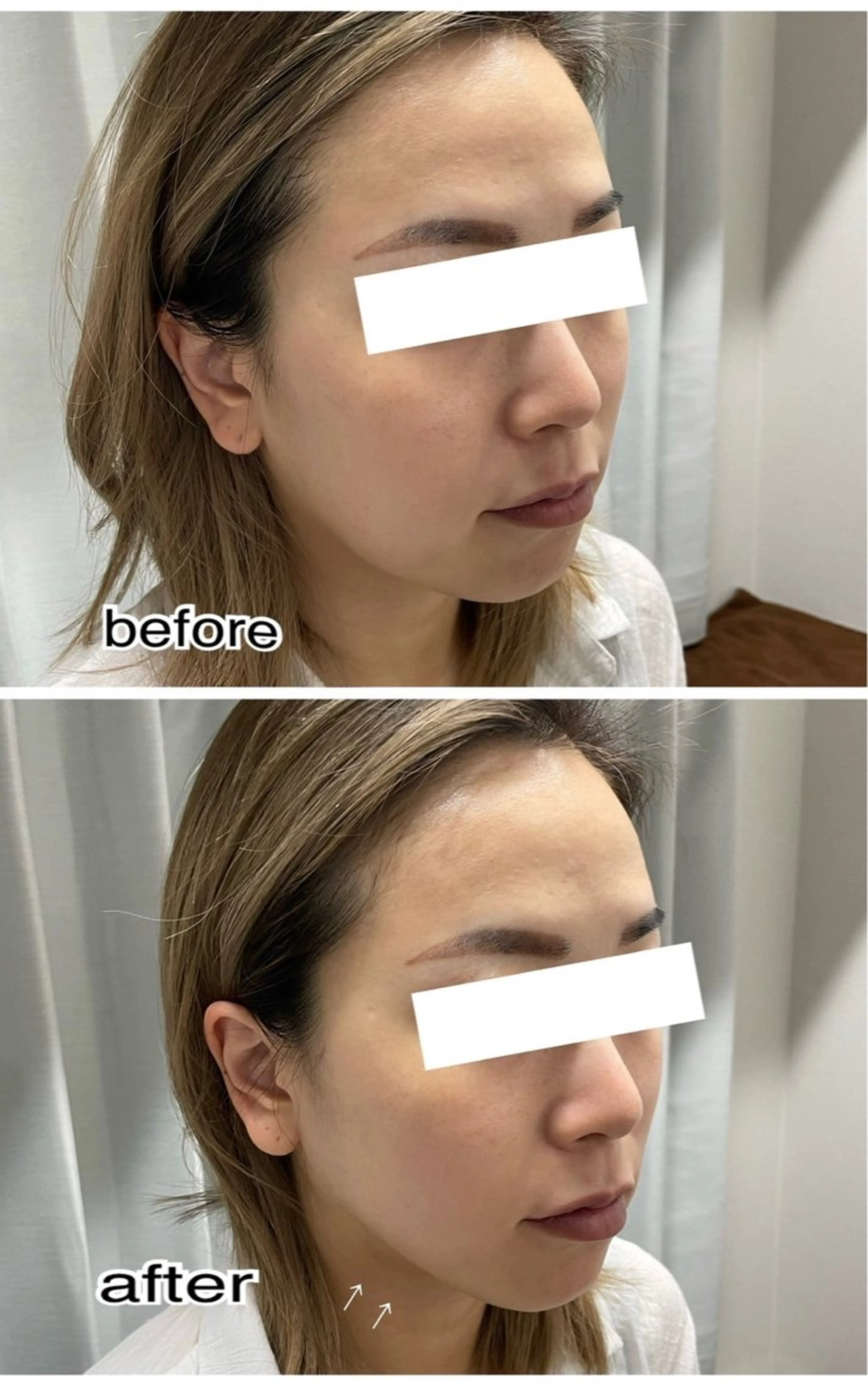 エステ ENCHANT Kaede/肌質改善のその他イメージ