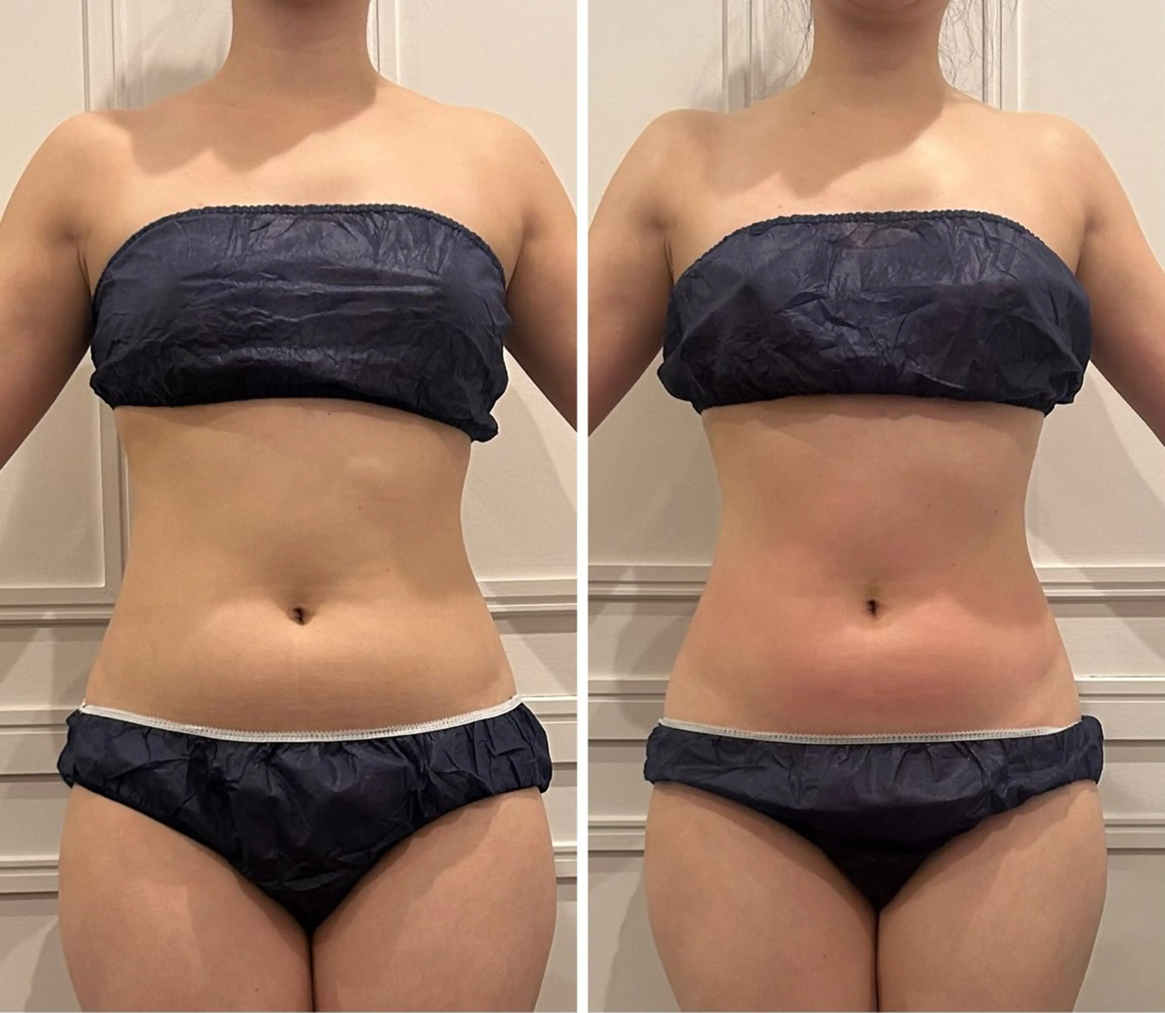 【ゲリラメニュー✔️】◎当日限定　ハイパーナイフEXで、気になる部位ワンパーツ施術✨の写真