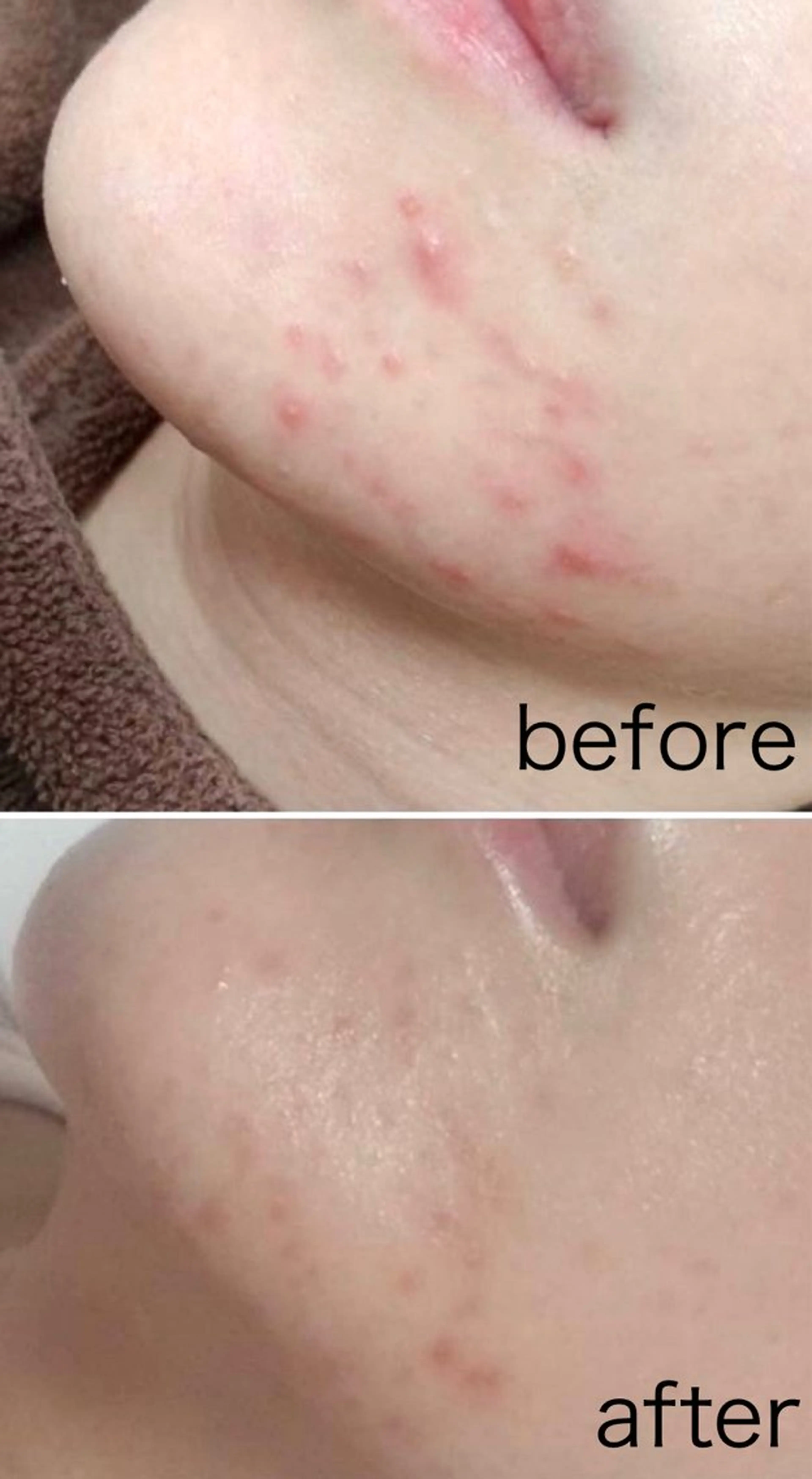 【ニキビケア】★ハーブピーリング※にきび・にきび跡・毛穴に!¥15,000→¥6000の写真