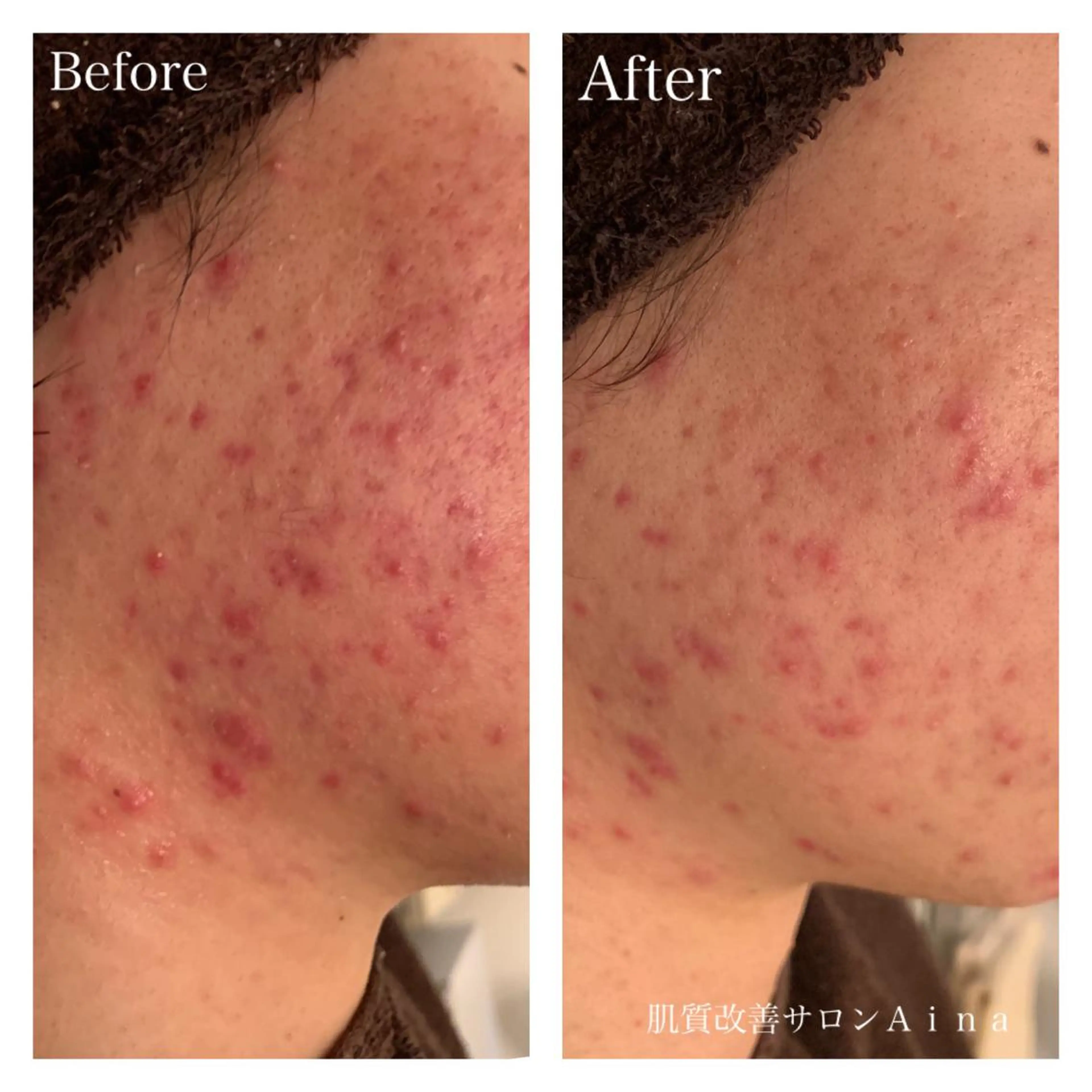 ミディアム パーマ キッズ ネイル マツエク・マツパ エステ リラク ニキビ跡専門サロン Ａｉｎａのエステ・リラクイメージ