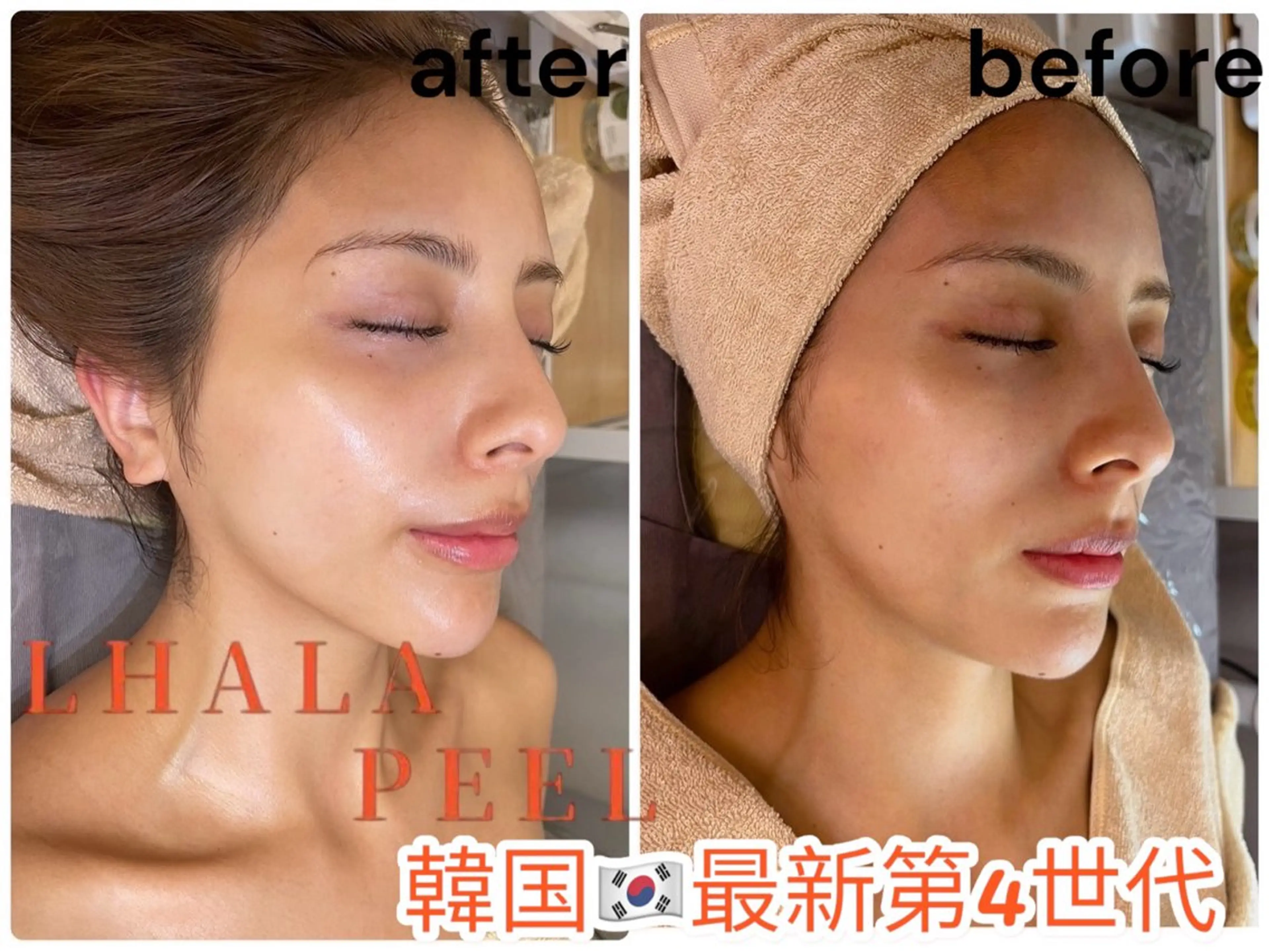 📣オープン記念/韓国最新第4世代ララピール3回券✨¥56250円→48000円の写真