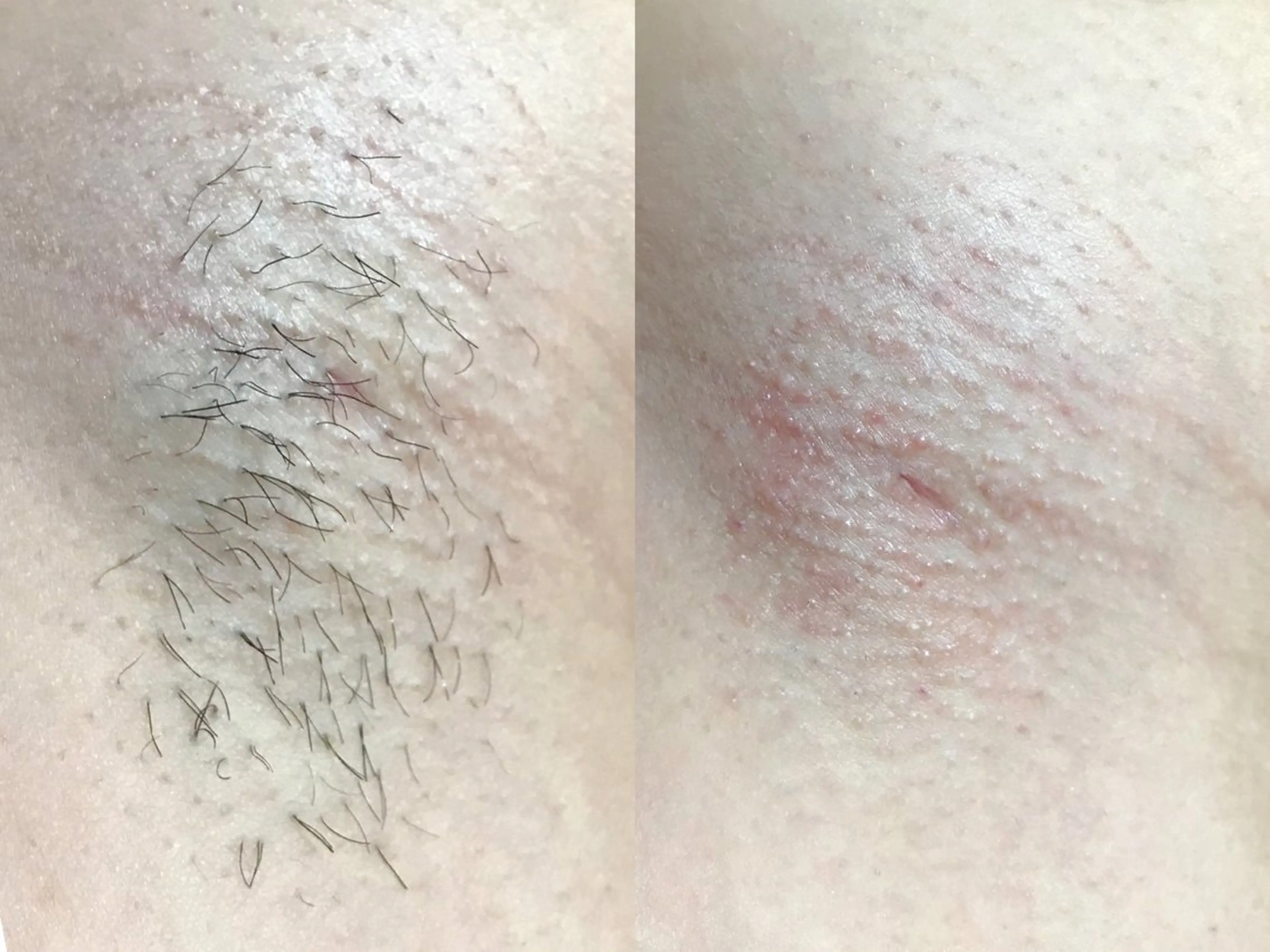 【ワキ脱毛】毛穴レスな脇を✨自信がもてる脇へ♡もう隠さないでいい脇になる！STOP🪒の写真