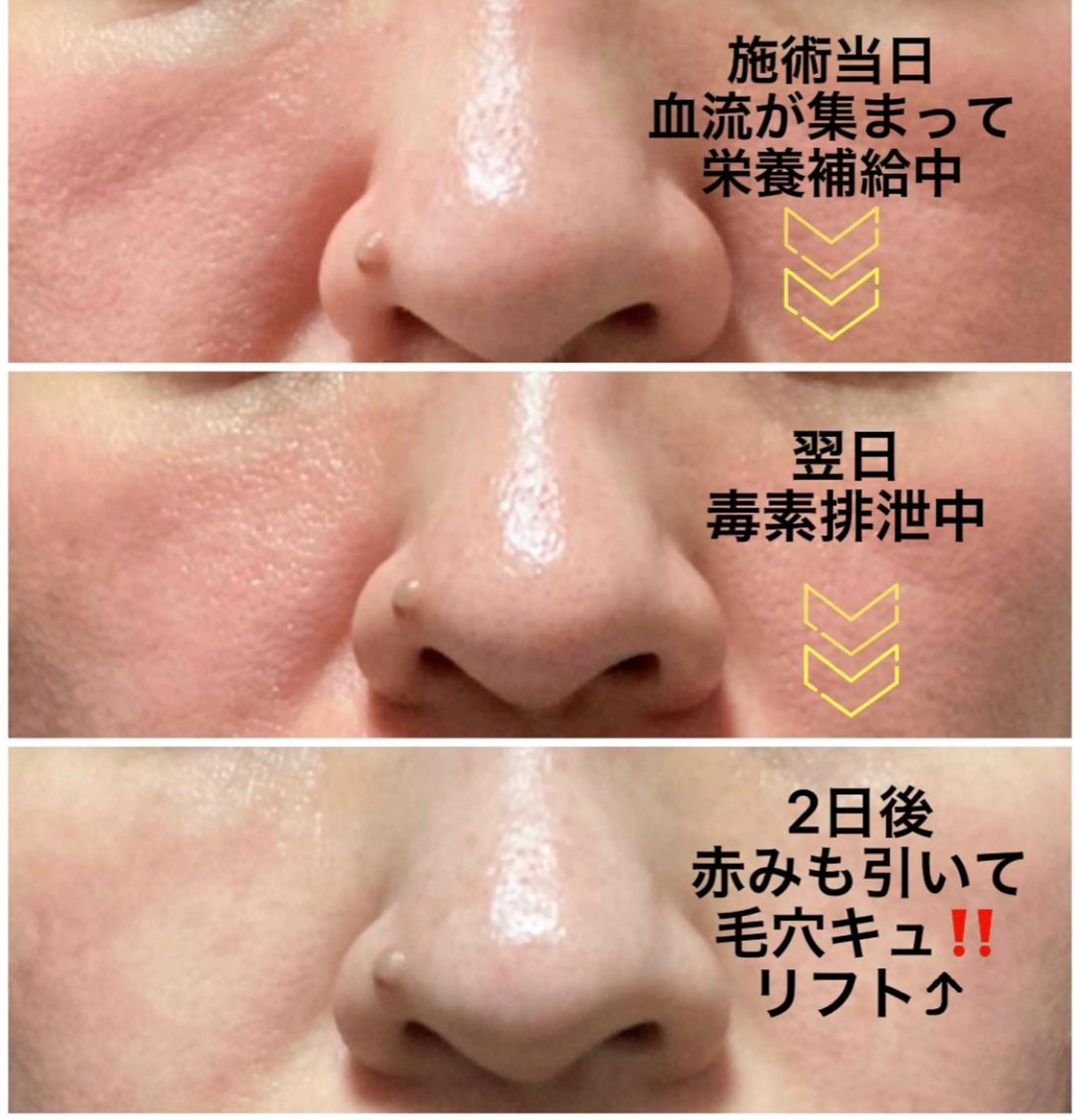 VOSサロンケア　頑固なニキビ、毛穴、シミに！の写真