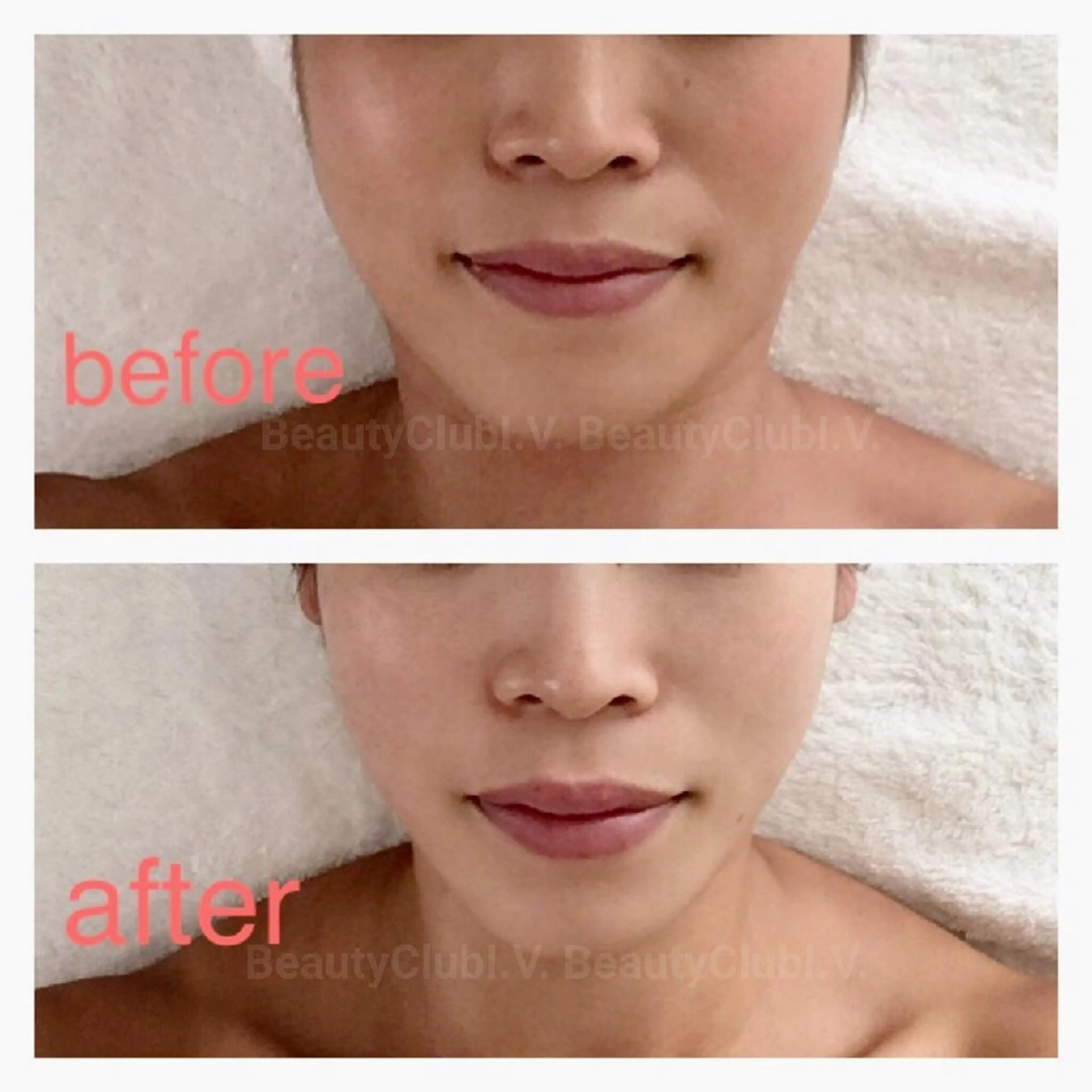 リフトアップフェイシャルの写真