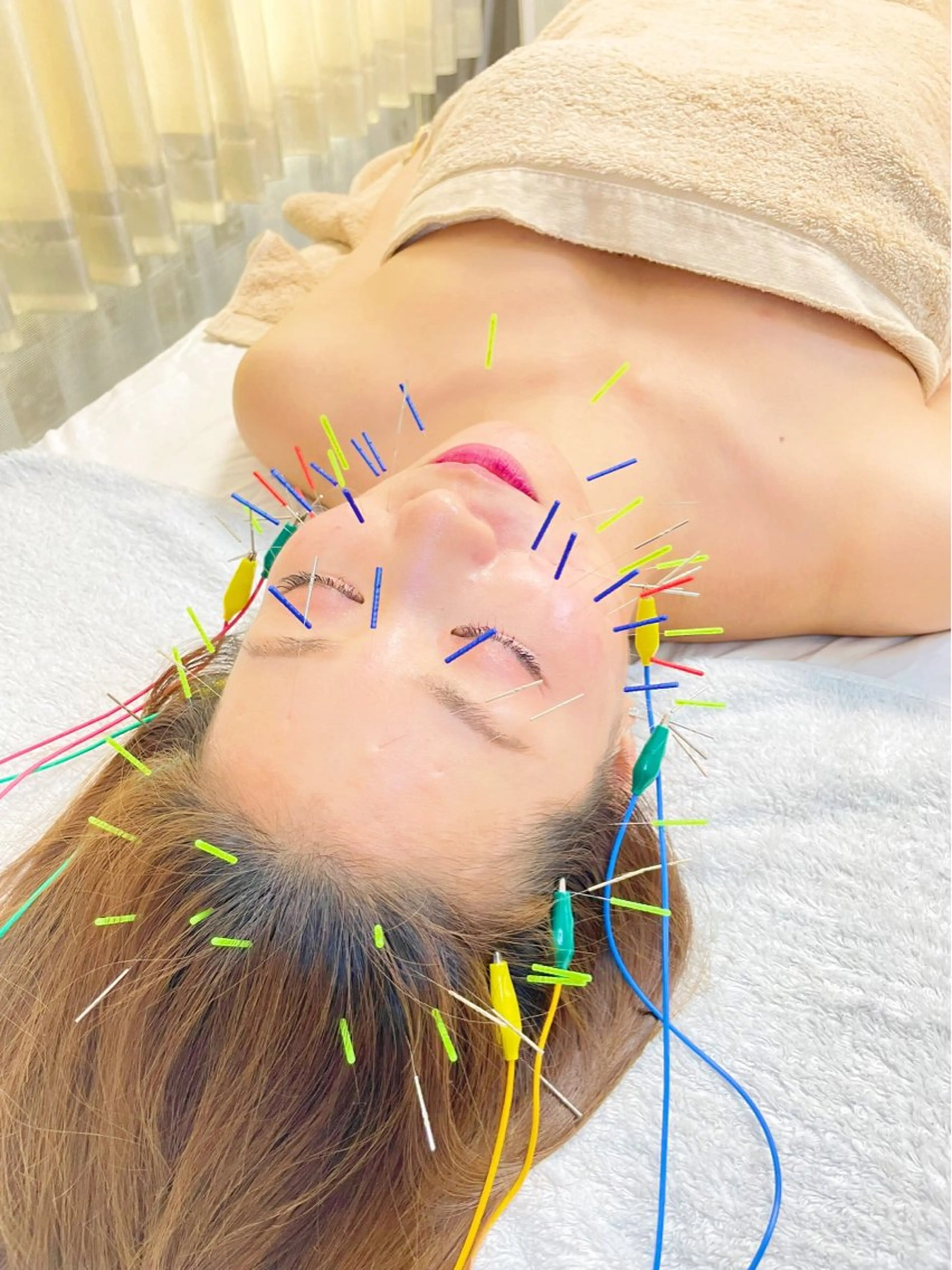 ミニモ学割🧑‍🎓🈹電気美容鍼＋頭首顔マッサージ💆‍♀️学生証提示必須⚠️スッキリ小顔リフトアップ✨の写真