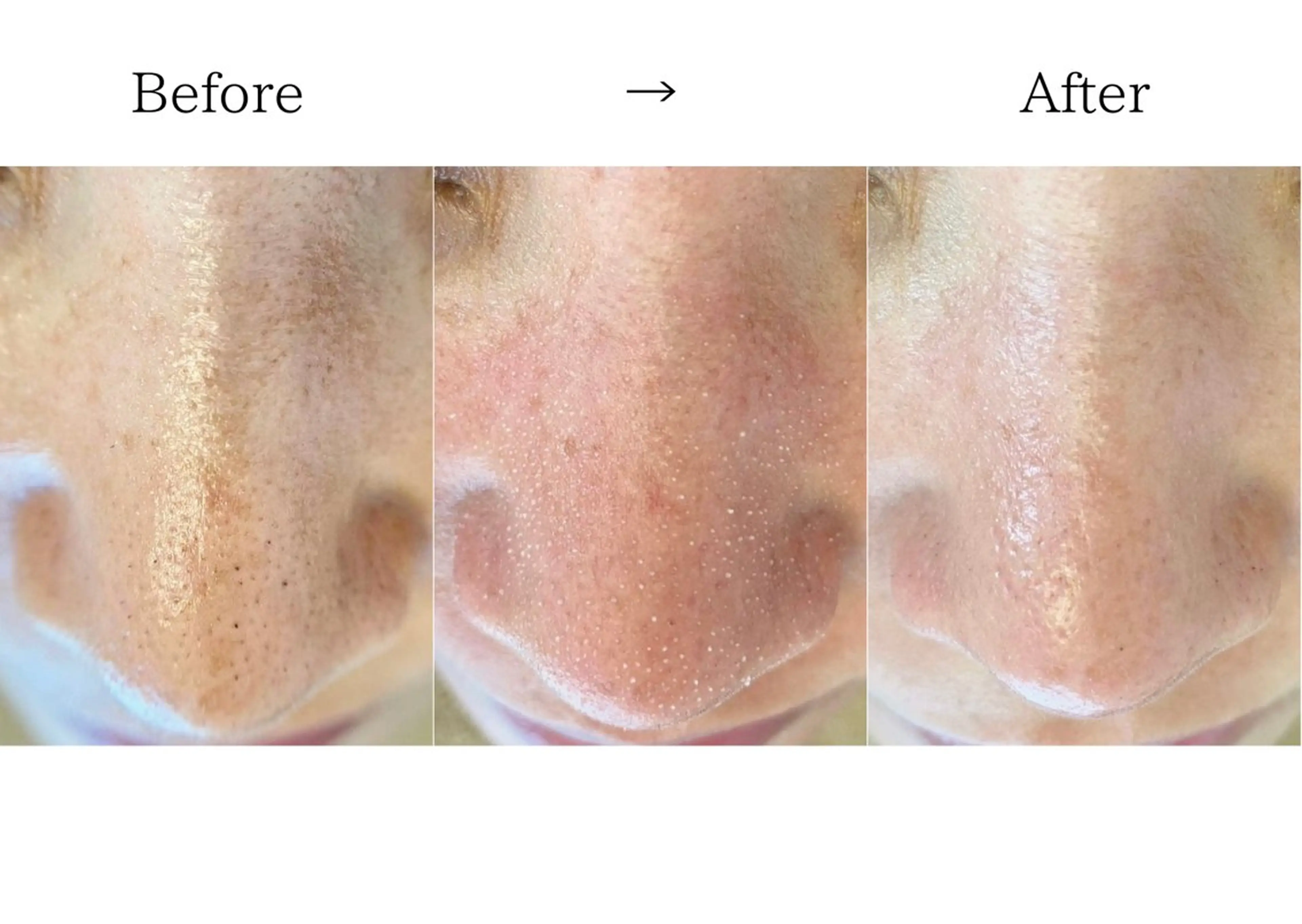 【極上たまご肌】韓国式3D毛穴洗浄 ¥46200→¥33000 3回setの写真