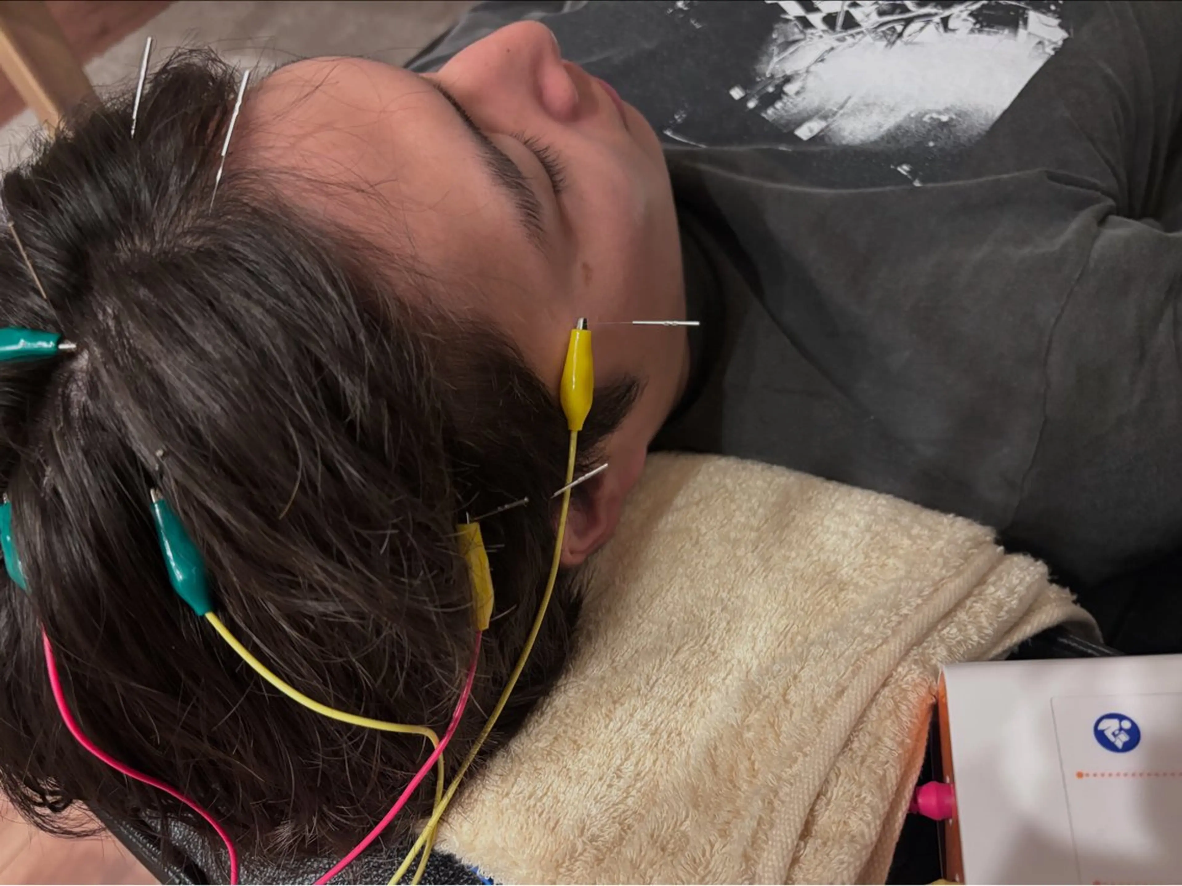 50分メニュー(美容鍼、整体、マッサージ)の写真