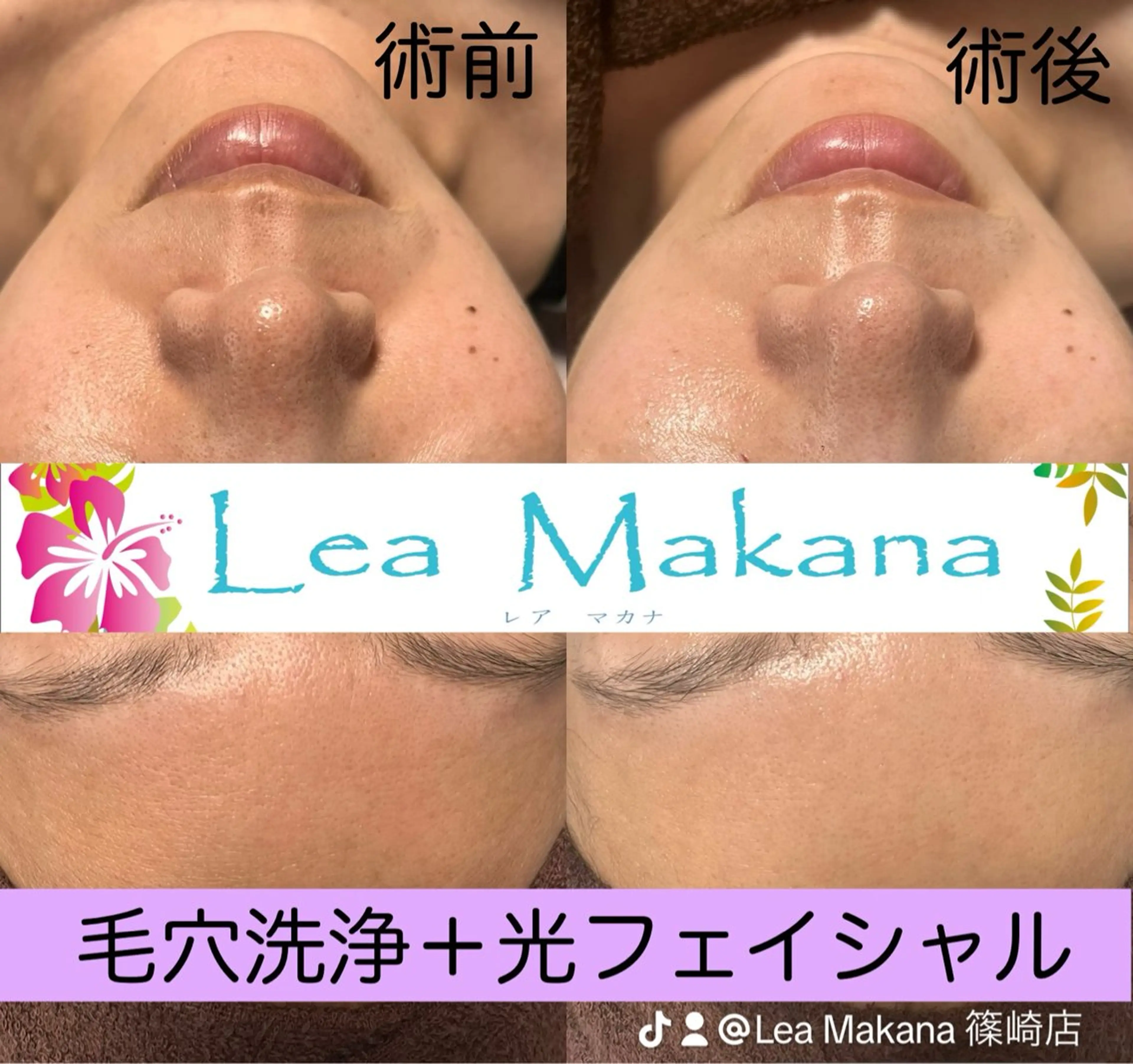 初回限定【毛穴洗浄＋光フェイシャル】黒ずみ、ザラつき、たるみ、シワ、シミ、リフトアップ✨の写真