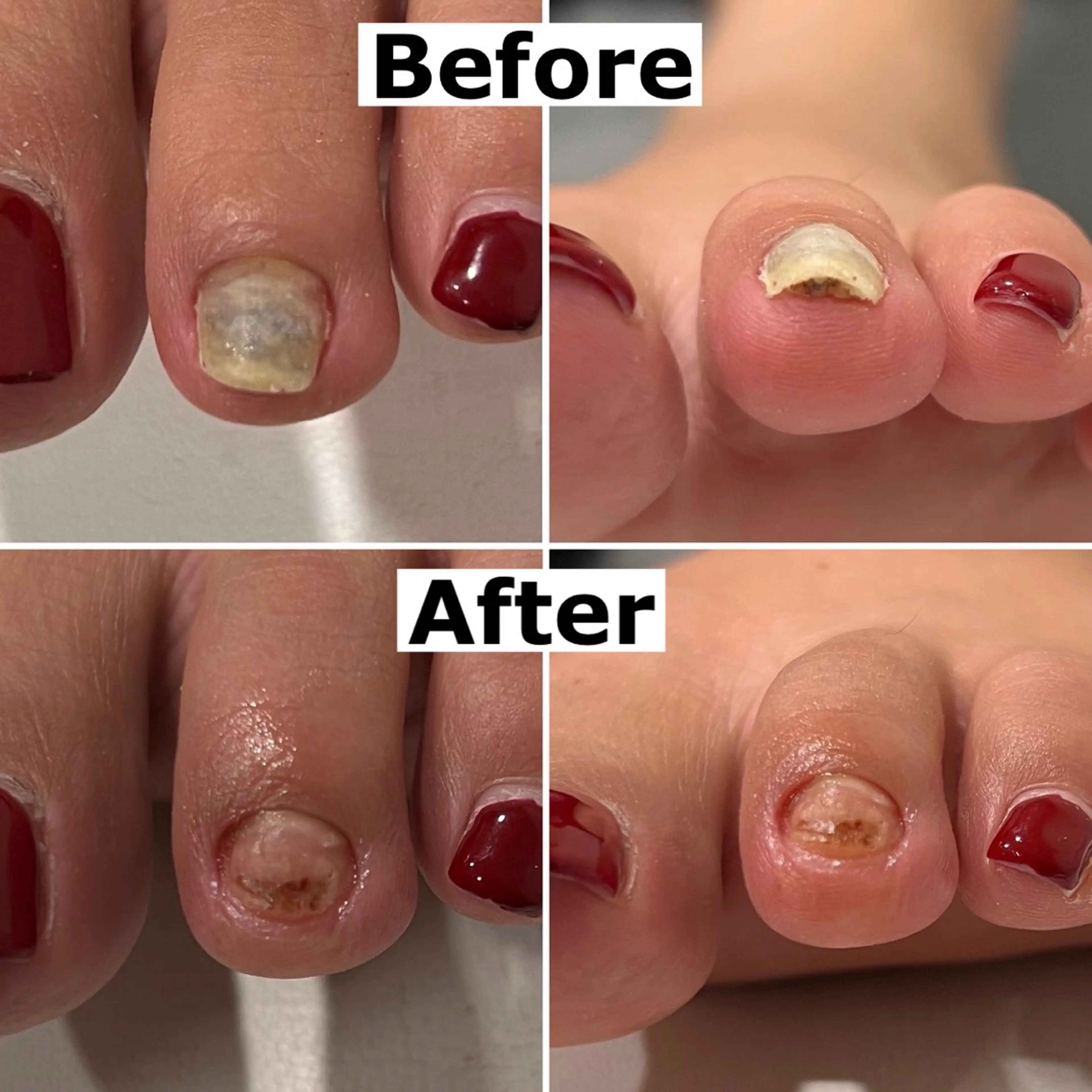 ネイル Mellow nail所属・巻爪無料モデル募集 ✨🦶MEGUMIのネイルデザイン