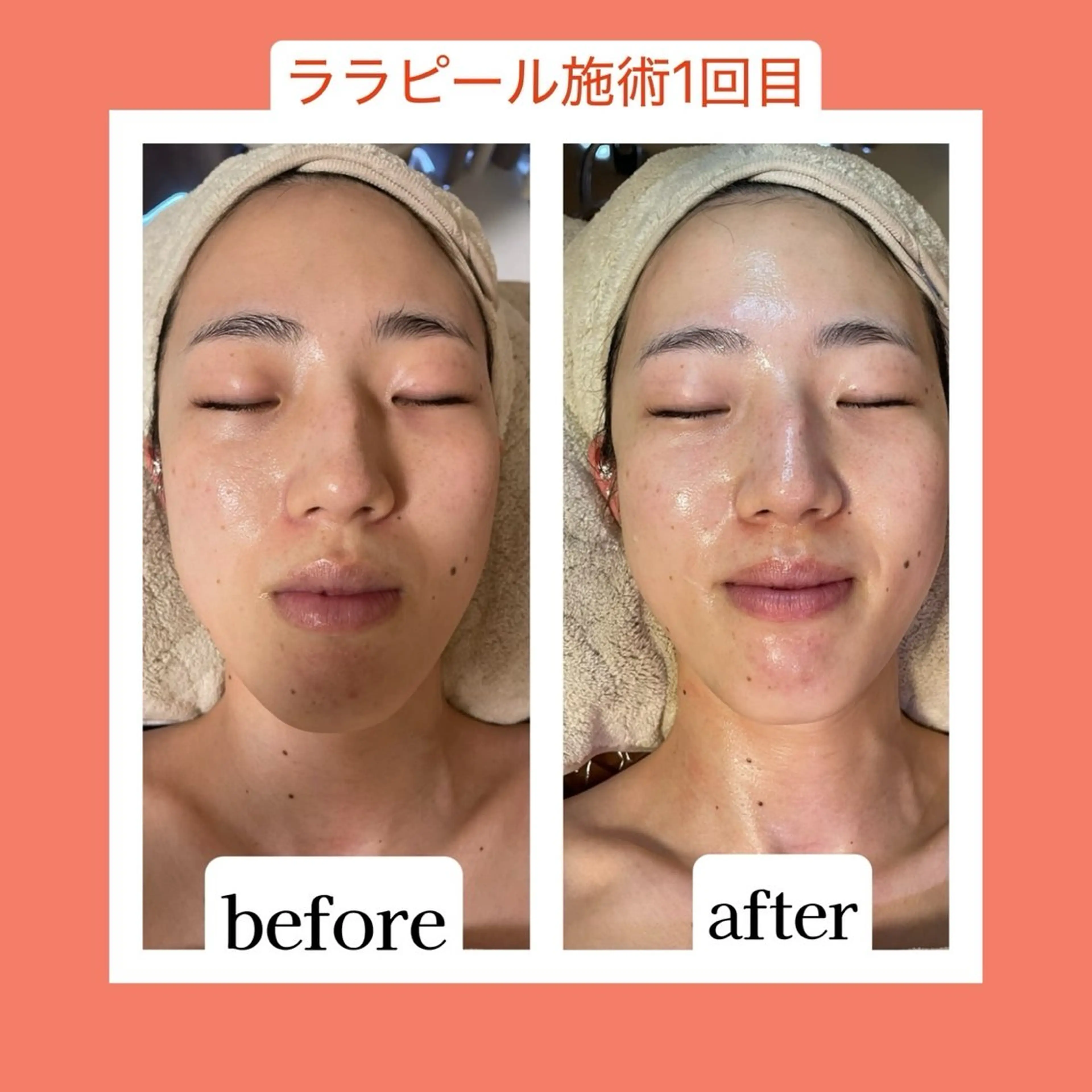 【柏最安値】ララピール🧴毛穴・くすみ改善✨韓国発の最新ピーリング💎デコルテ付き¥8500の写真