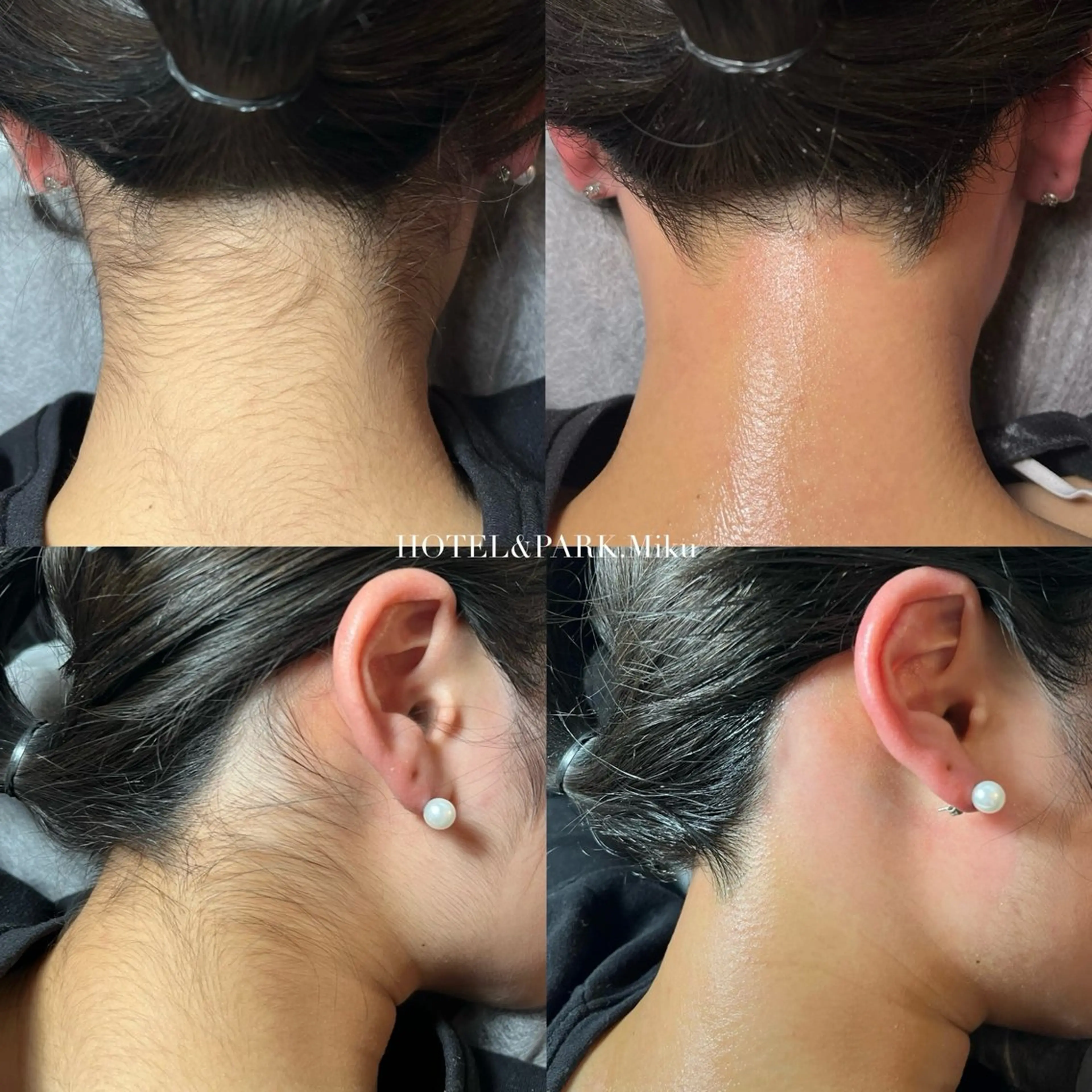 HOLIDAY SALE🎄🎅🏽 40%OFF❤️【VIO+うなじワックス脱毛】の写真