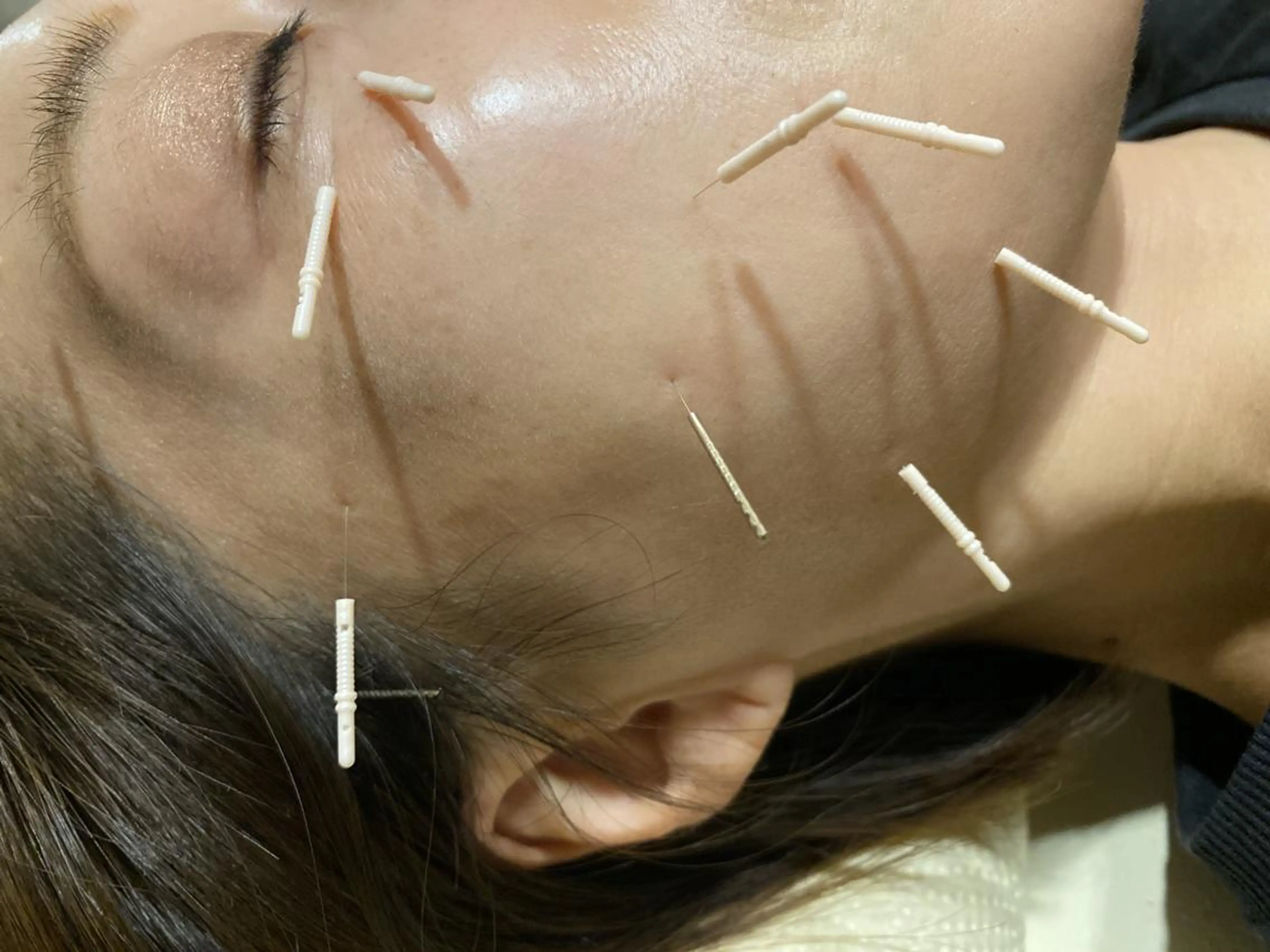 むくみたるみ専門☆ 美容鍼・小顔矯正のエステ・リラクイメージ