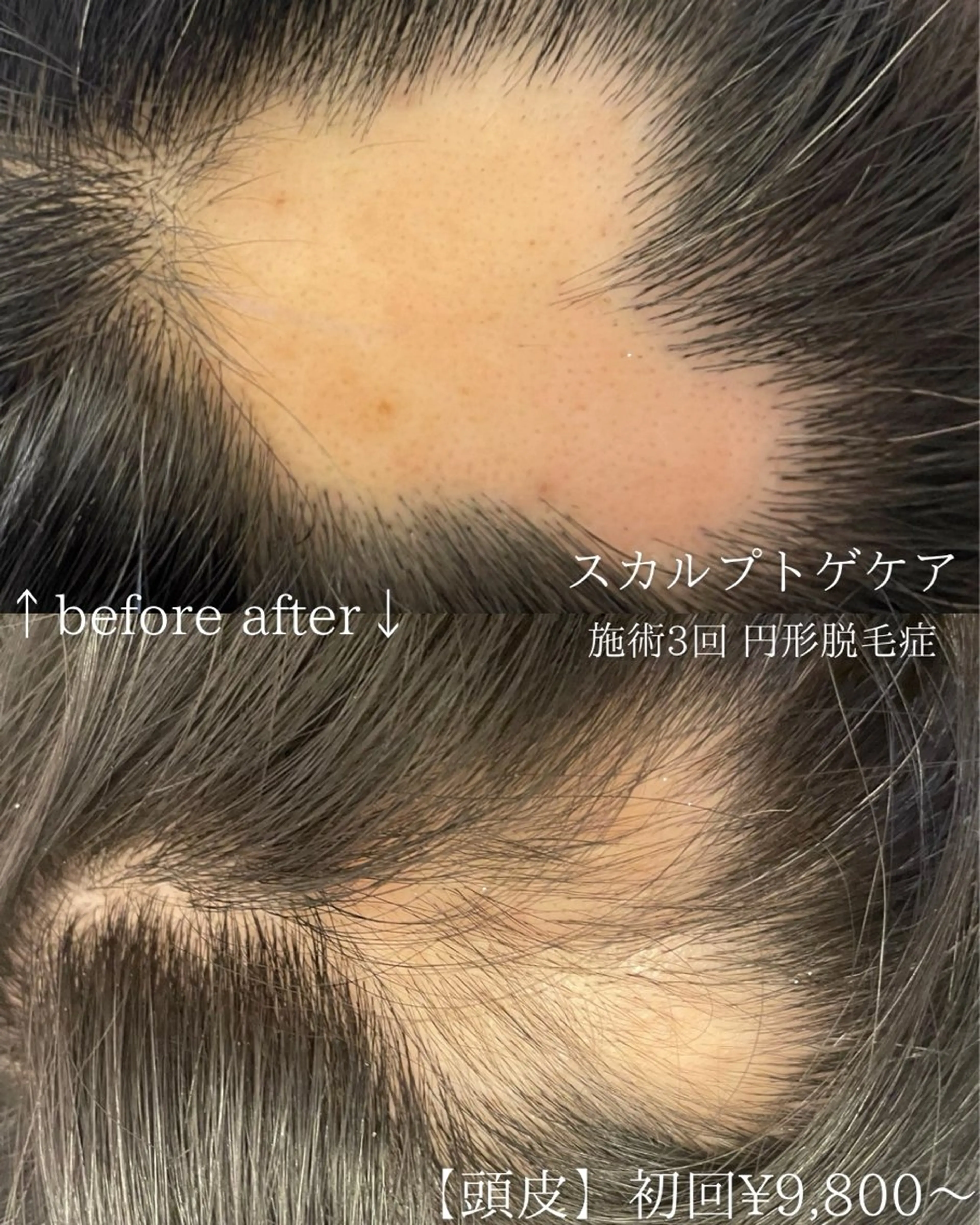 【薄毛】【円形脱毛】【分け目】スカルプトゲケア！毛根に栄養をたっぷり与えて、毛根生き生きと蘇らせる！再生ケアの写真