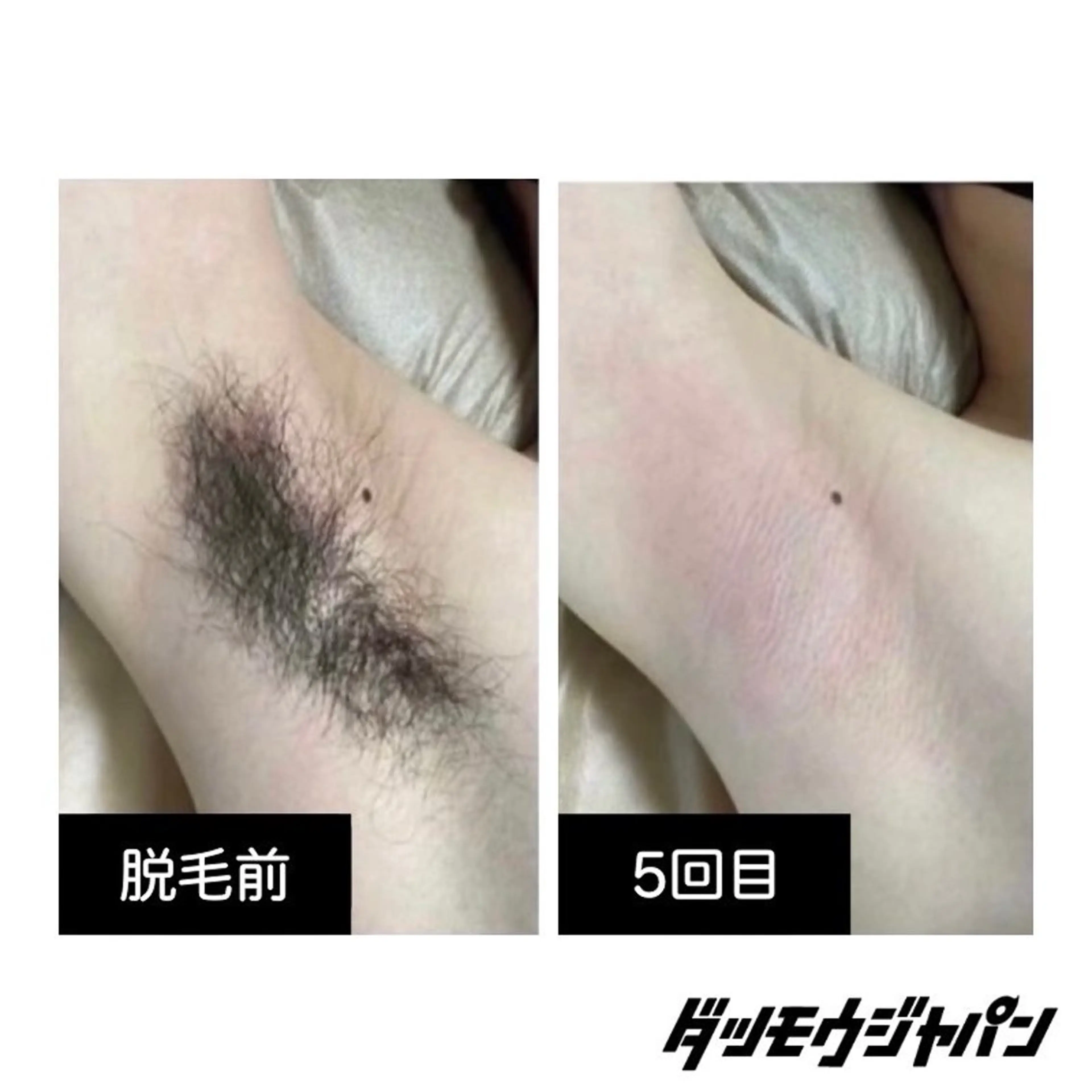 メンズ 脱毛 メンズ脱毛JAPAN東広島店🇯🇵所属・メンズ脱毛JAPAN 東広島店🇯🇵のエステ・リラクイメージ