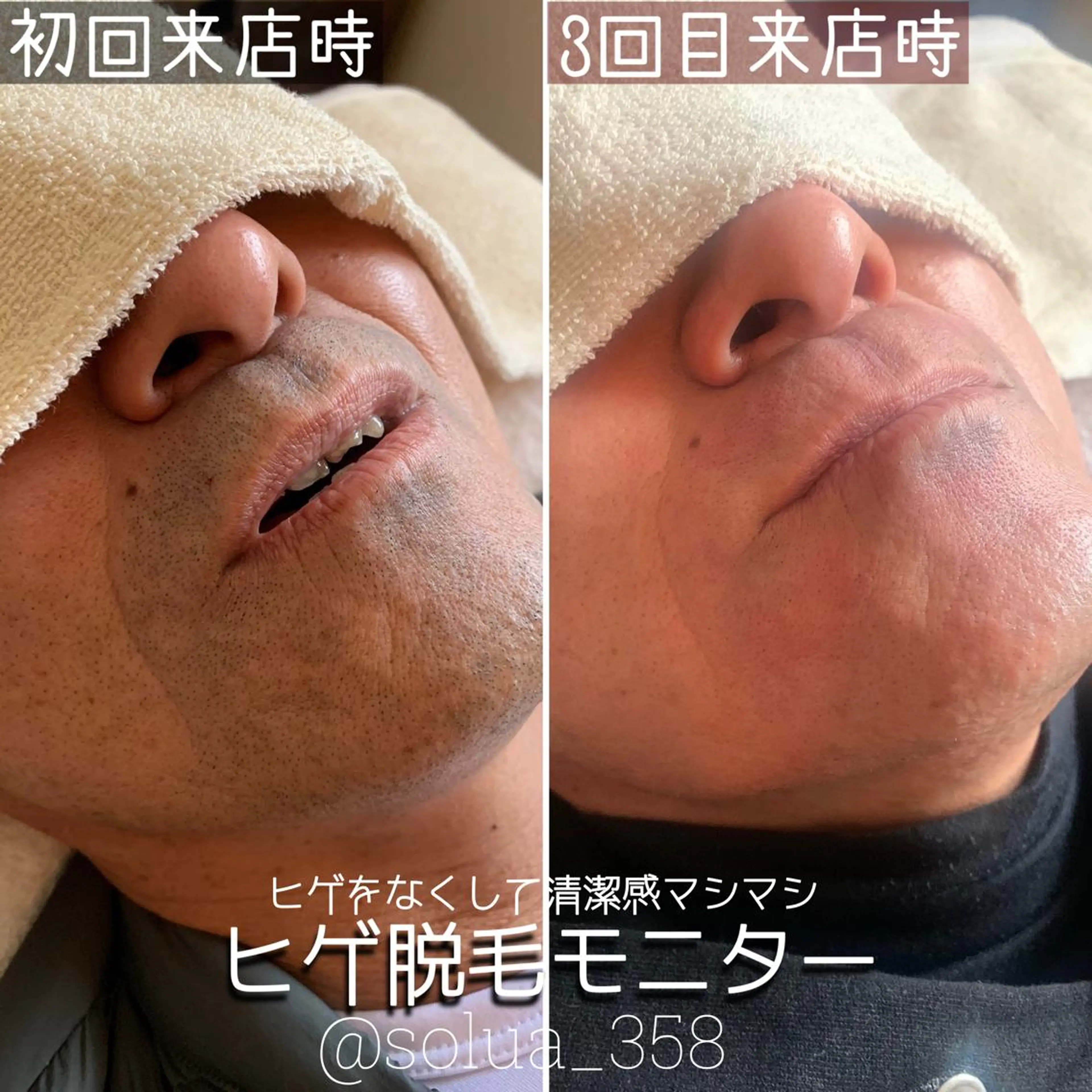 [再来]メンズヒゲ脱毛モニター💆🏻‍♂️※定員埋まり次第掲載終了⚠️メンズもツルスベ肌をスタンダードに❣️の写真