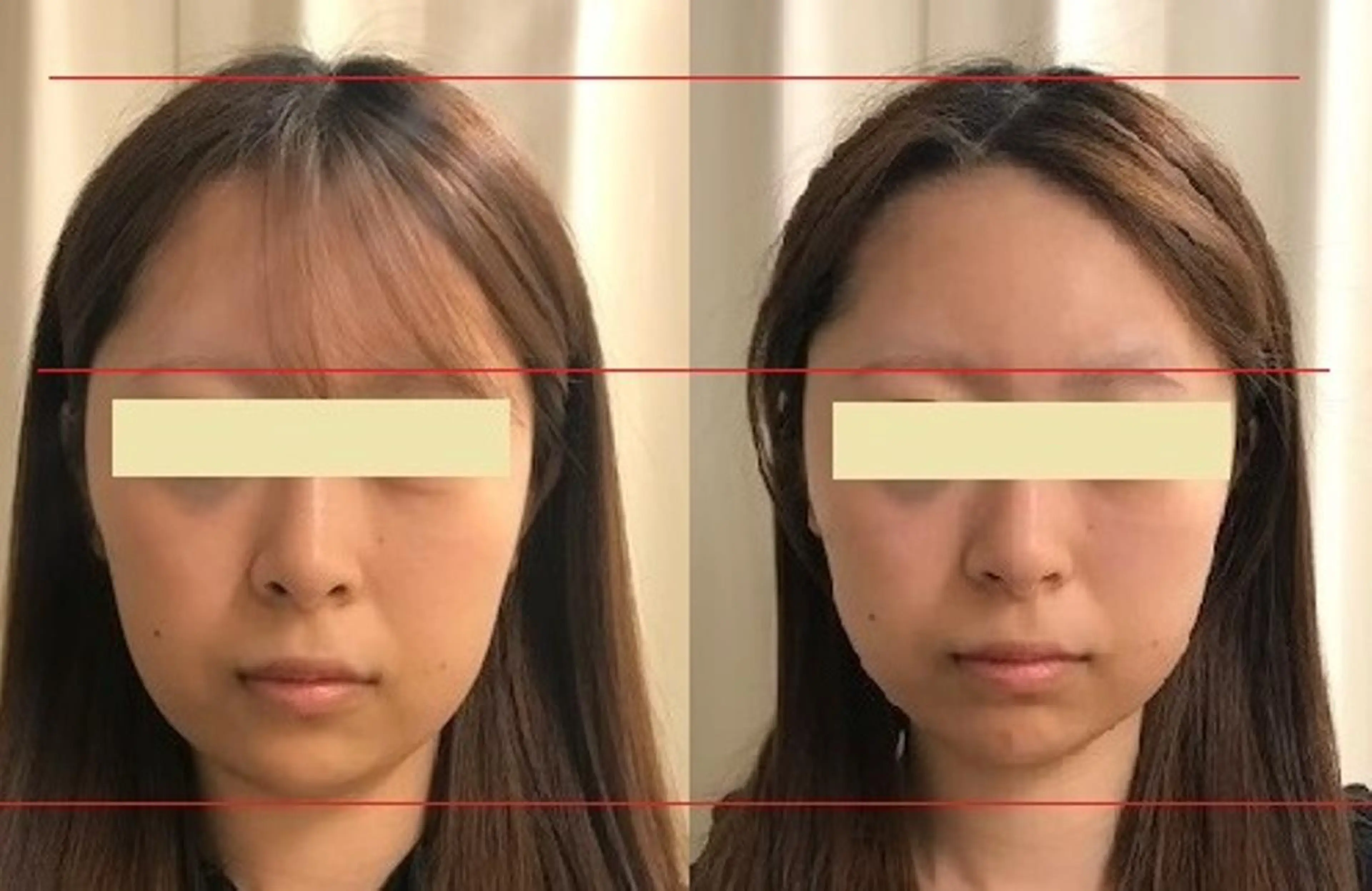 エステ 顔脱毛＆毛穴＆ニキビ 優良№1♪ヒロコ♪のエステ・リラクイメージ