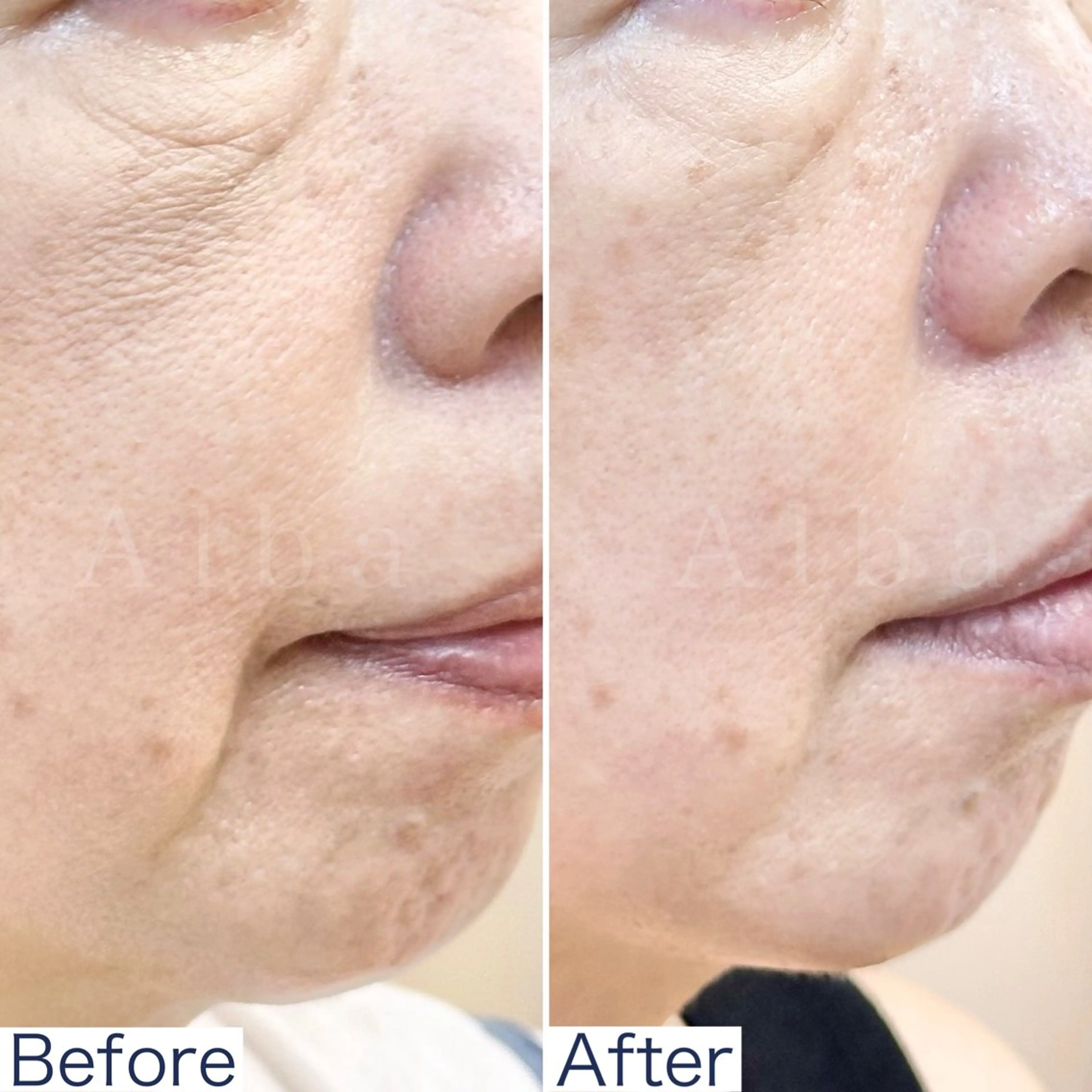 美容鍼灸60分の写真