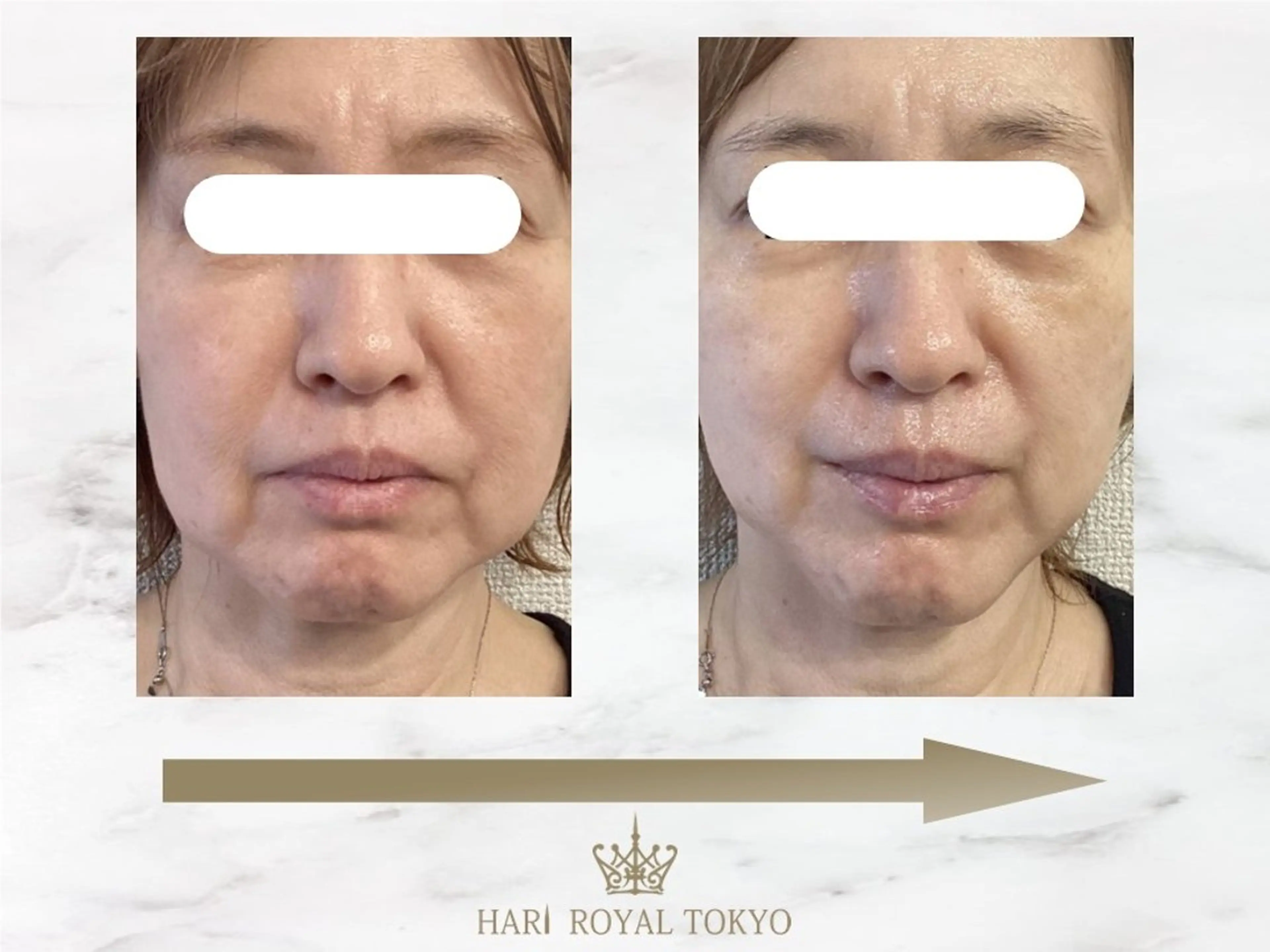 ハリロイヤルトーキョー武蔵小山所属・ニューハーフ鍼灸師 🖤🤍Saya🌹のエステ・リラクイメージ