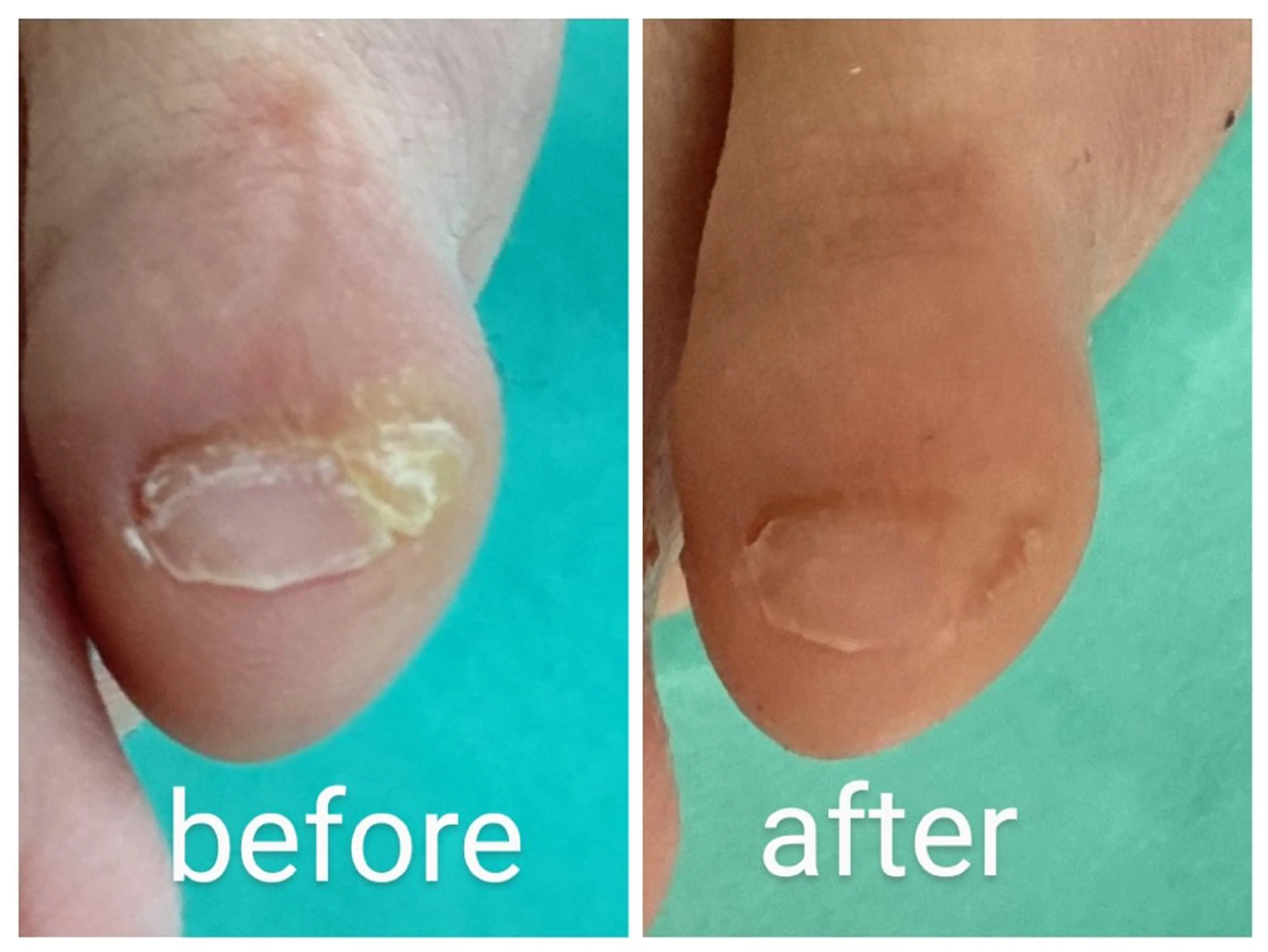 巻き爪補正店 大阪なんば店のネイルデザイン