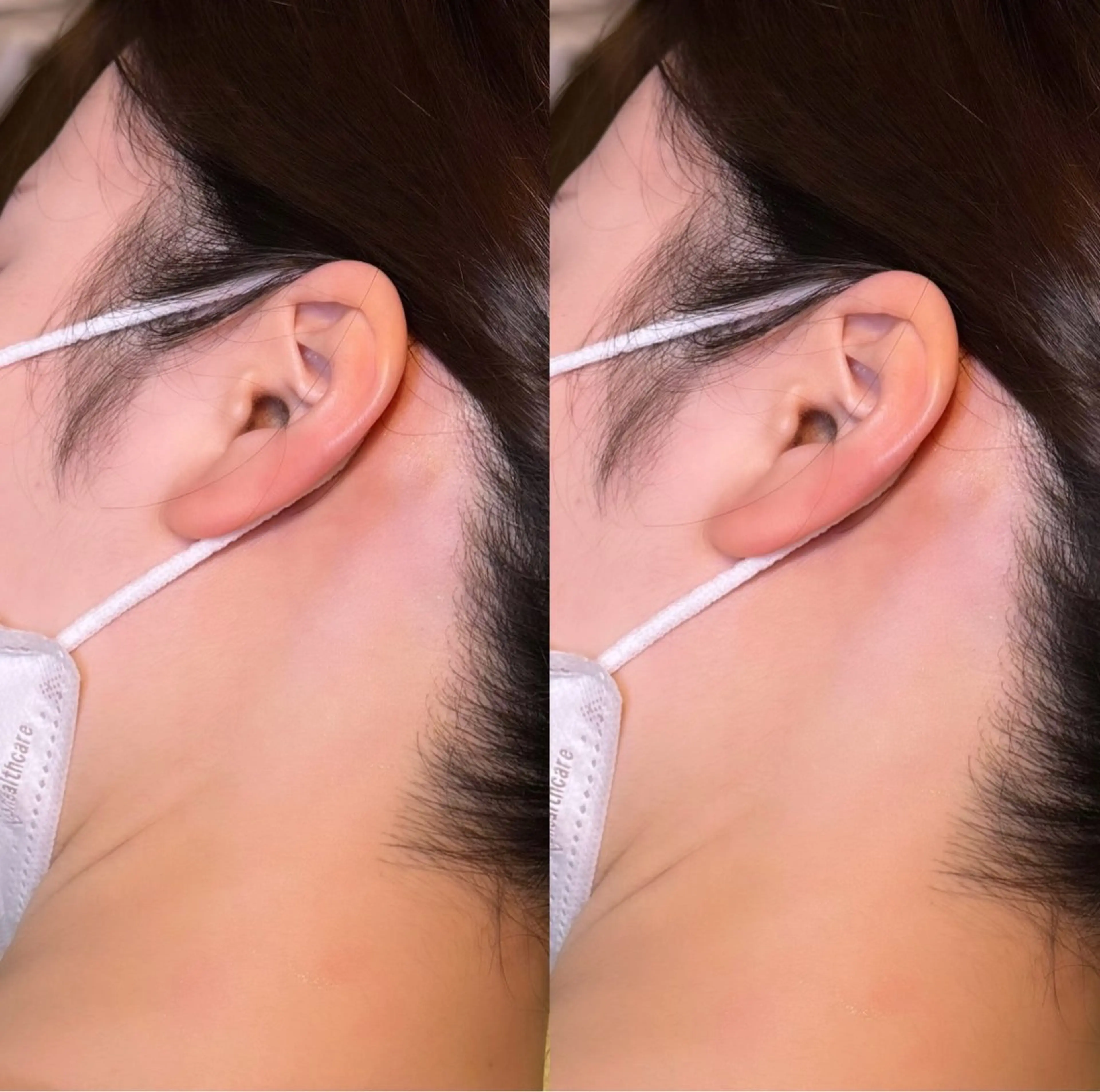 うなじWax脱毛🍯✨の写真