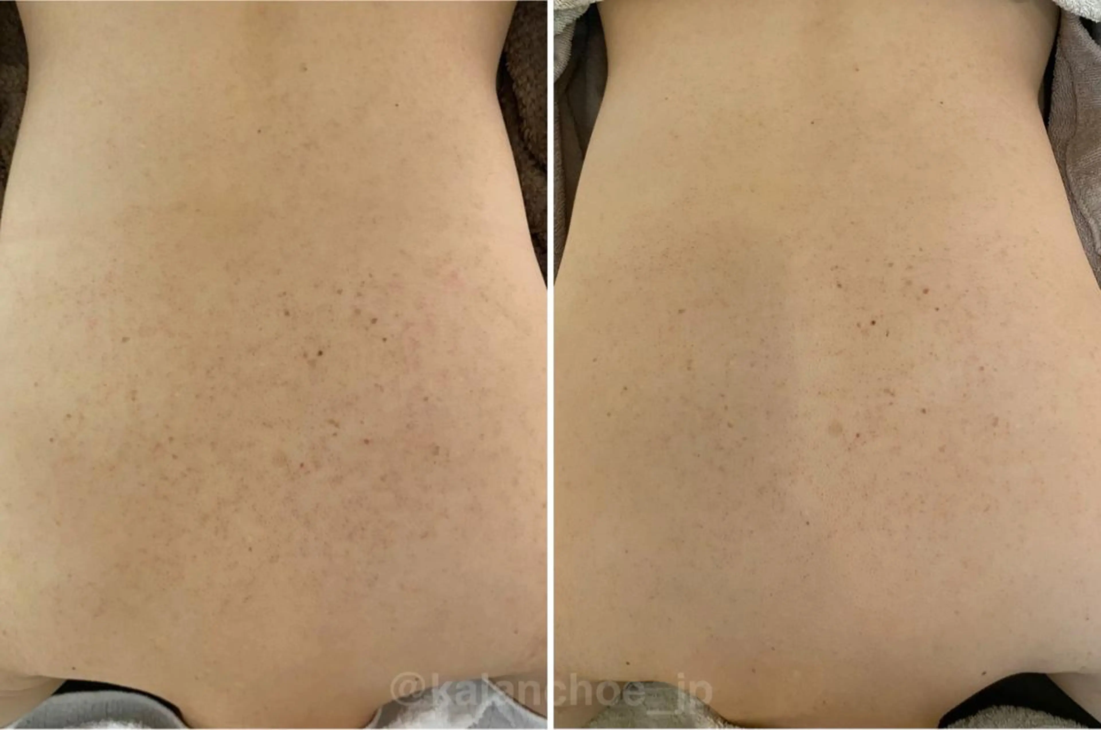 肌質改善 KALANCHOEのエステ・リラクイメージ