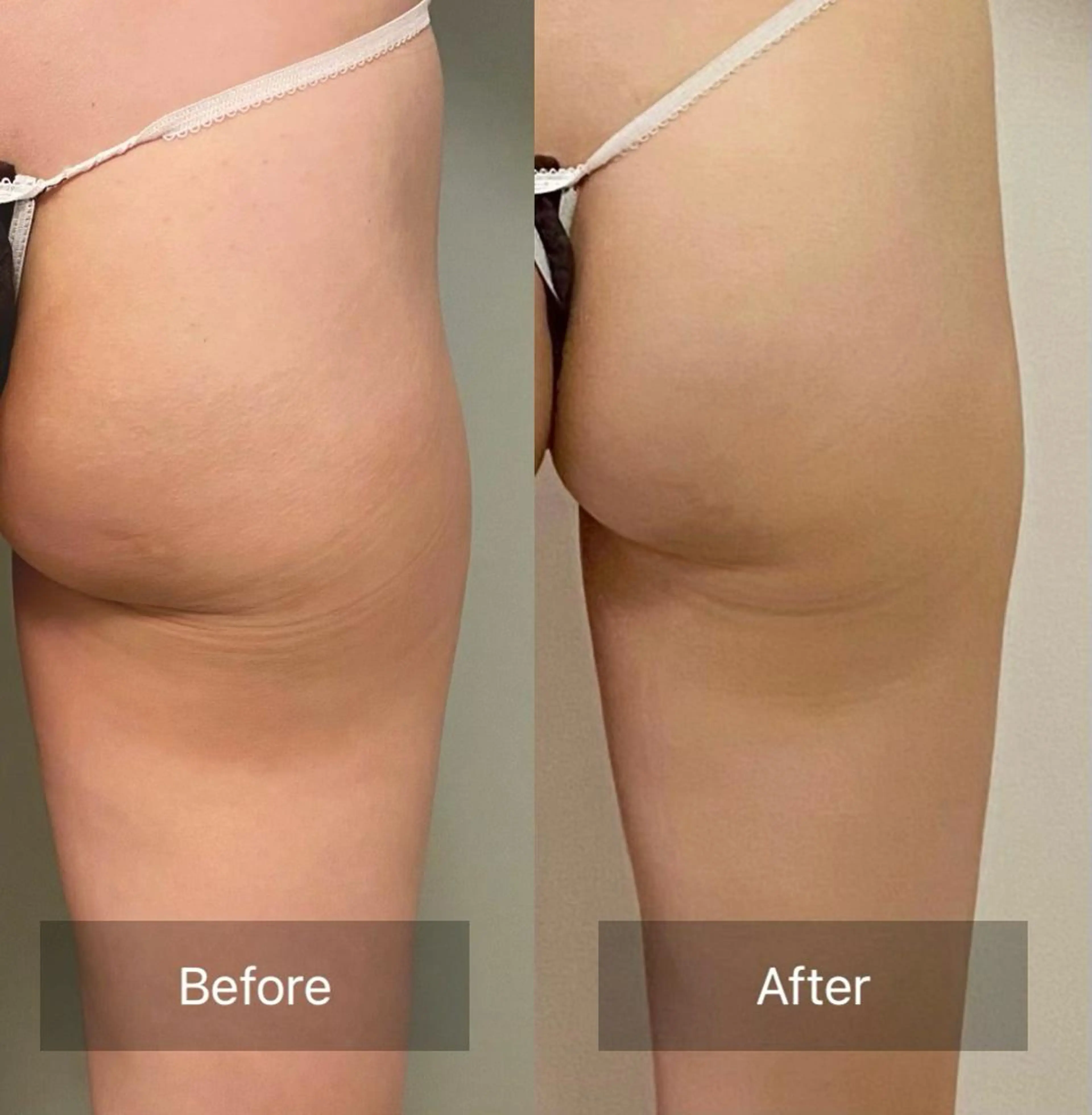 🍑まんまるヒップ🍑小尻・美尻ケア　30分の写真