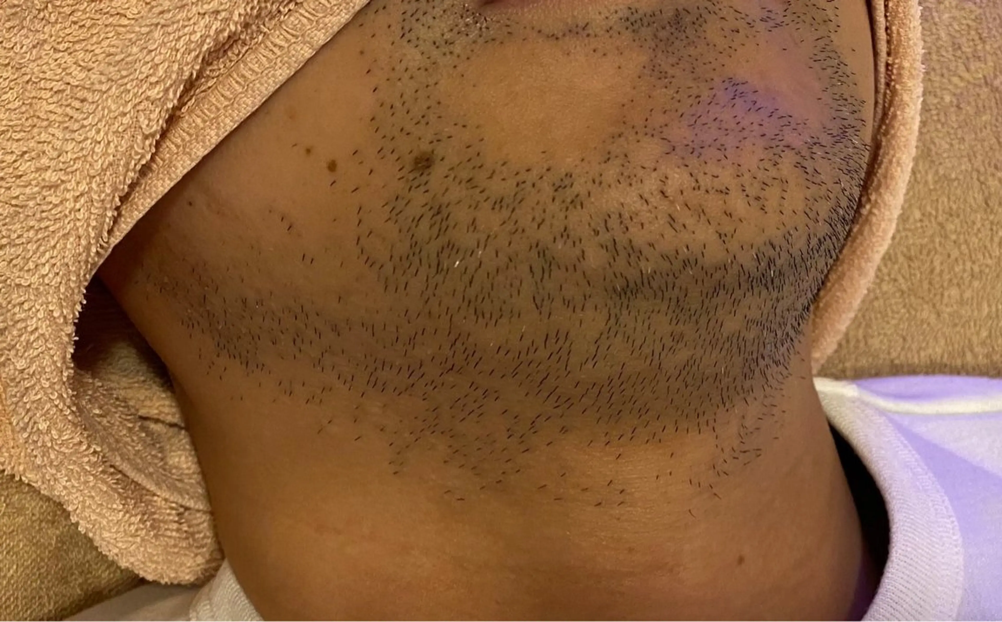 メンズヒゲ脱毛全体の写真