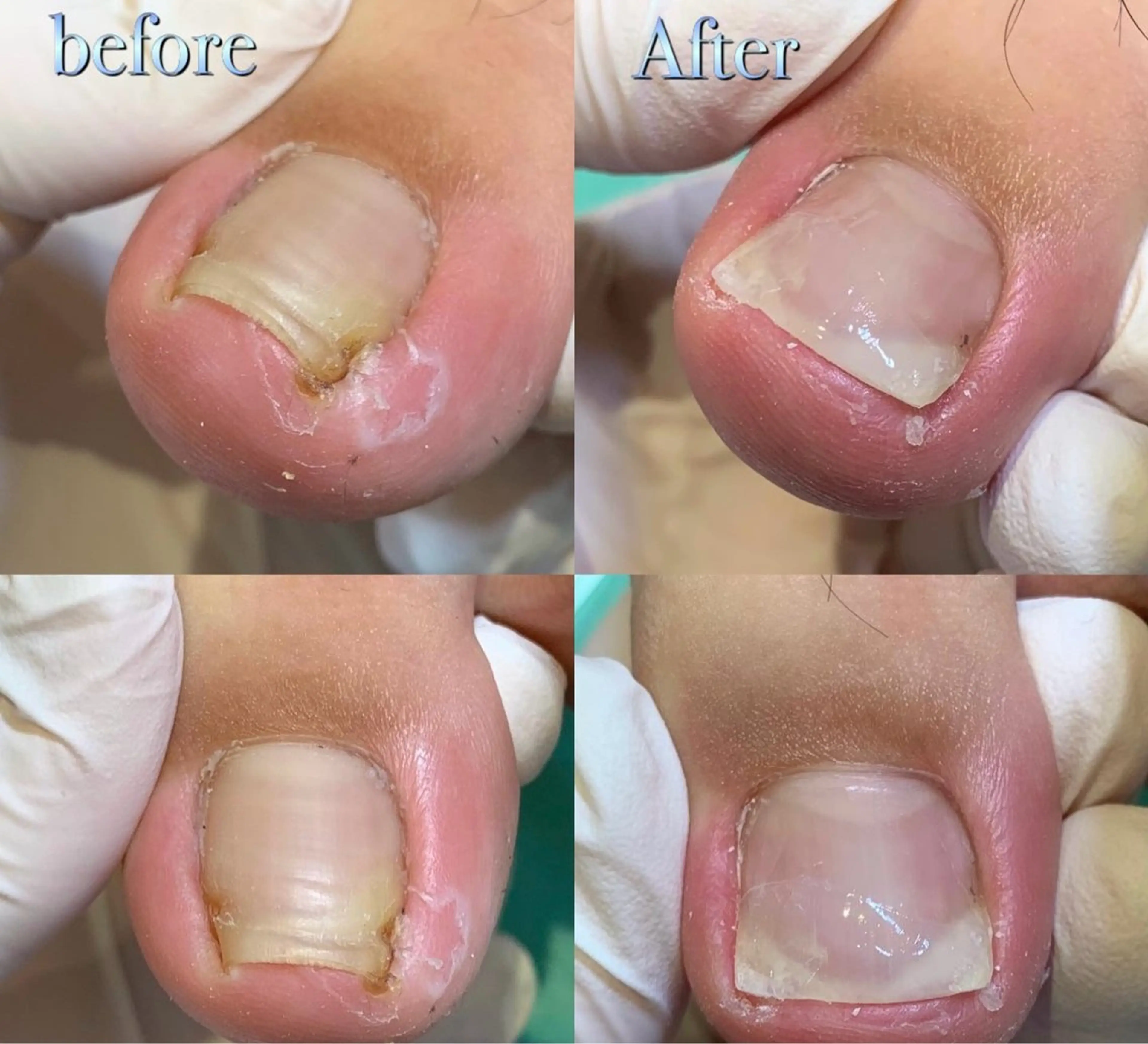 【陥入爪補正】2か所の巻き爪補正✨皮膚に沈み込んだ爪も矯正器具でキレイに再生✨生活の痛みや違和感を改善致します💡の写真