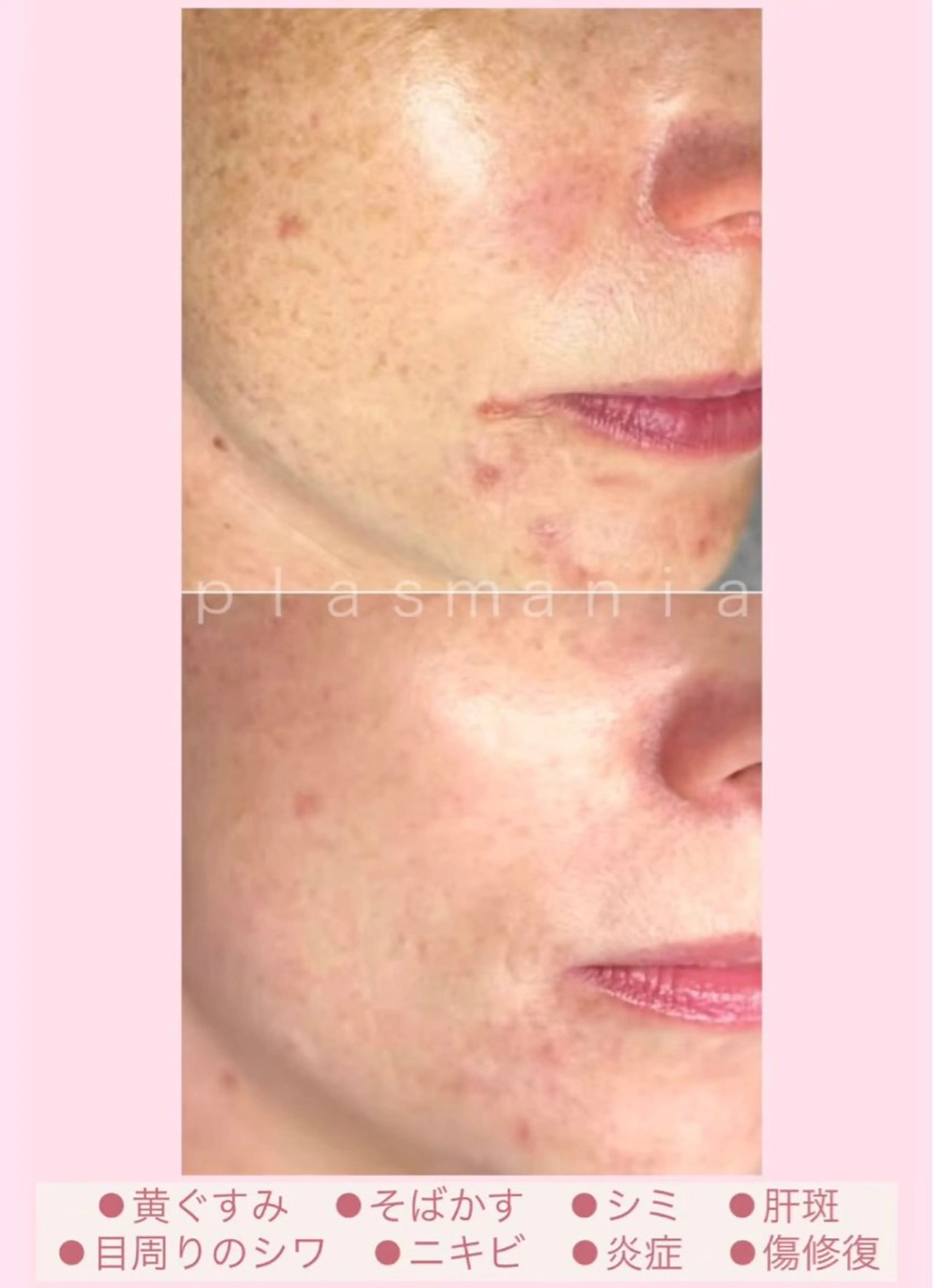 12月限定《思春期ニキビ・ニキビ跡》殺菌して美容液をグングン入れるの写真