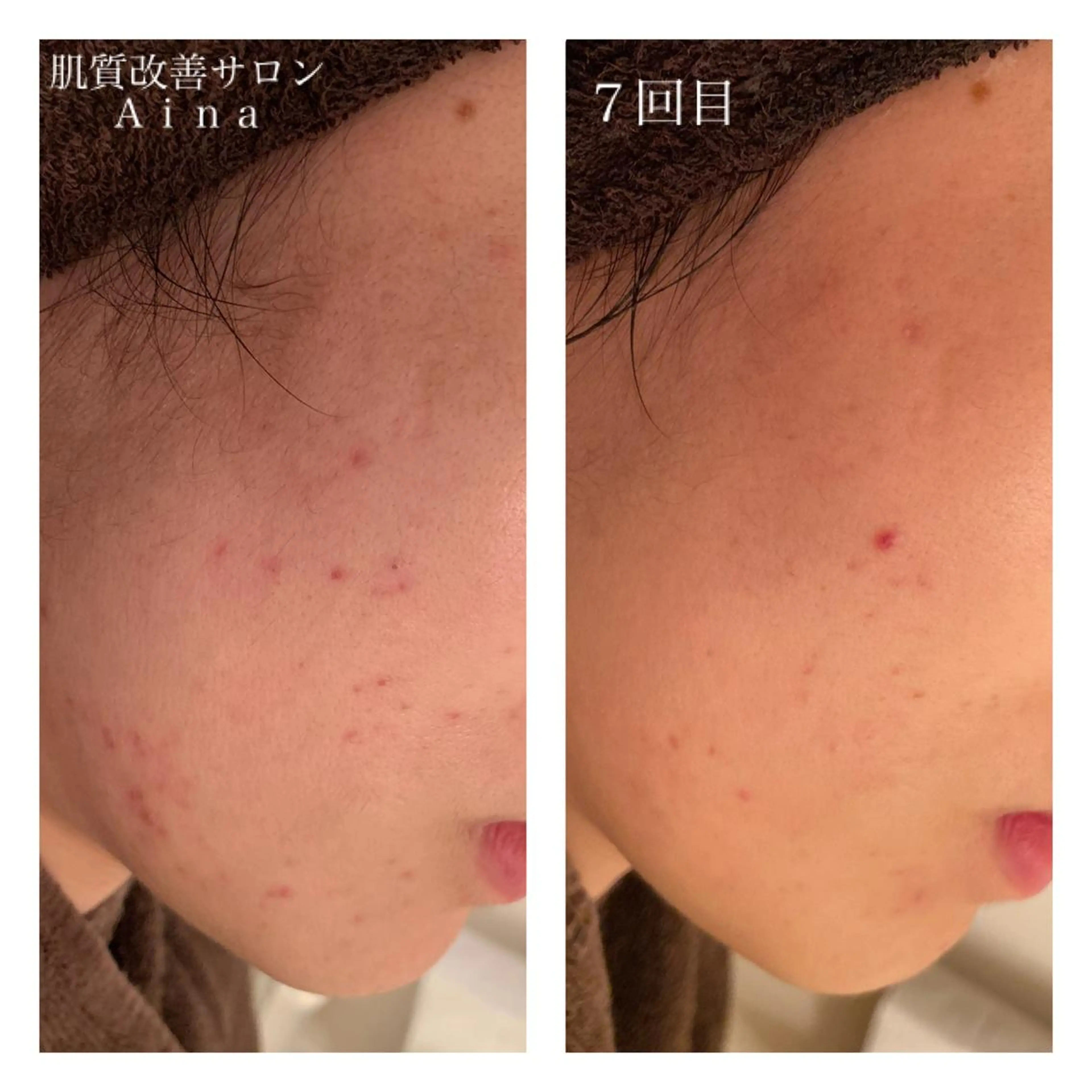 セミロング カラー パーマ ヘアアレンジ メンズ キッズ マツエク・マツパ エステ リラク ニキビ跡専門サロン Ainaのエステ・リラクイメージ