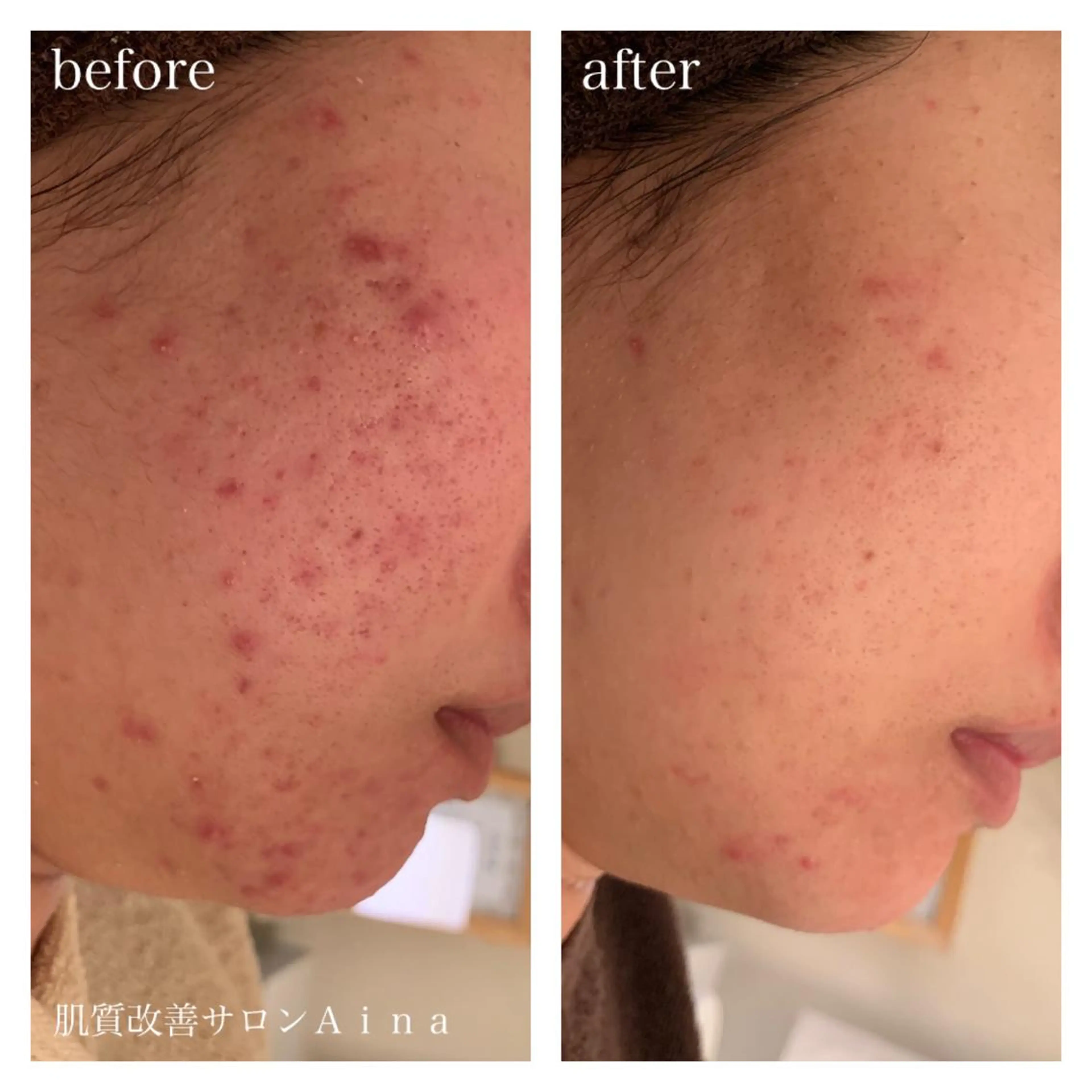 ロング カラー パーマ ヘアアレンジ メンズ キッズ ネイル マツエク・マツパ 卒業式のヘアスタイル 卒業式 エステ リラク ニキビ跡専門サロン Ａｉｎａのエステ・リラクイメージ