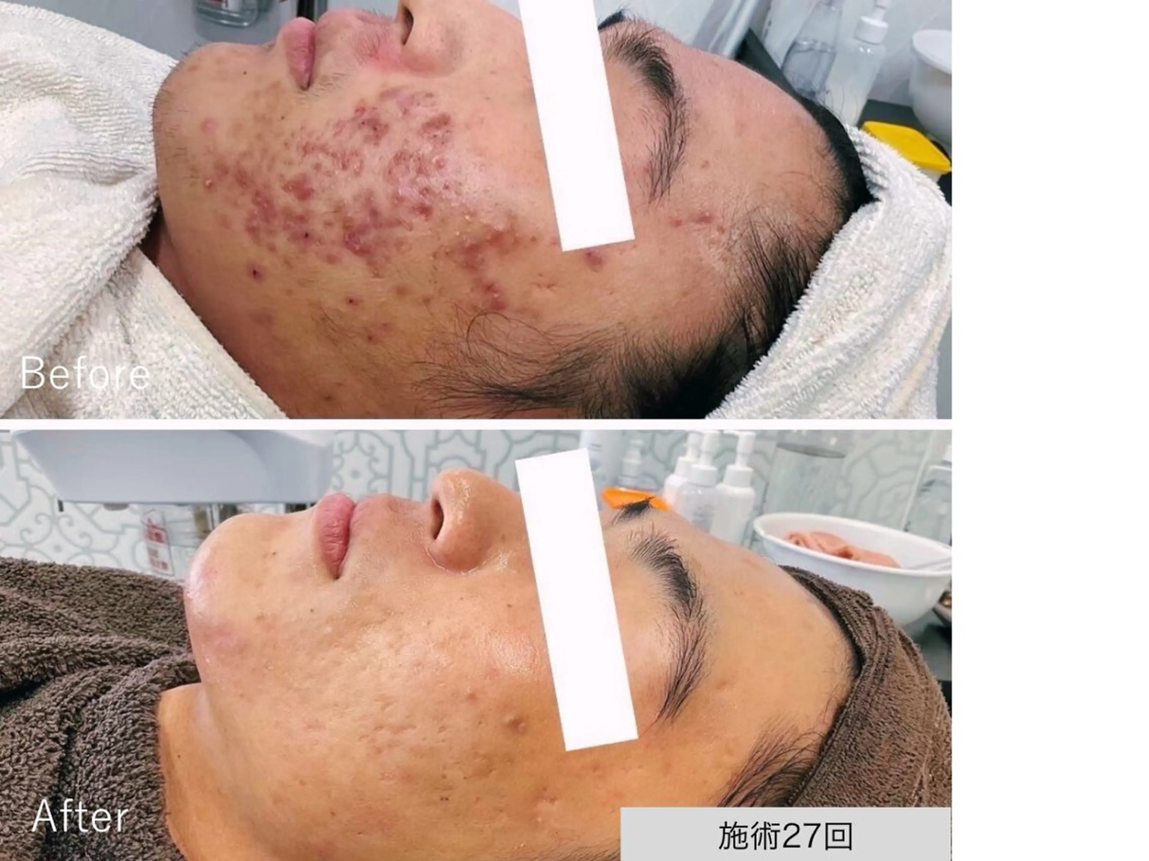 【肌荒れ原因・肌を知る】相談・肌診断・洗顔指導 肌が変わる第一歩◎の写真